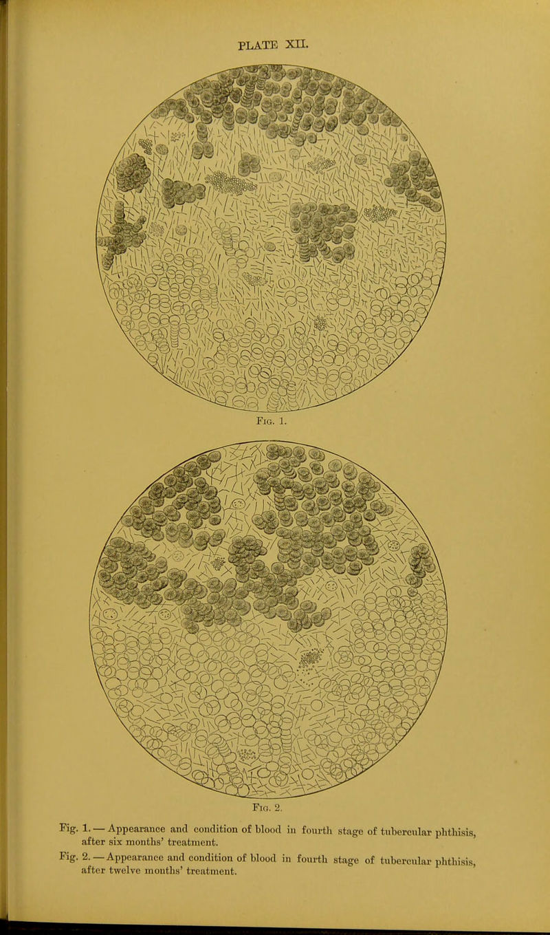 Fig. 2. Fig. 1. — Appearance and condition of blood in fourth stage of tubercular phthisii after six months' treatment. Fig. 2.—Appearance and condition of blood in fourth stage of tubercular phthisii after twelve months' treatment.