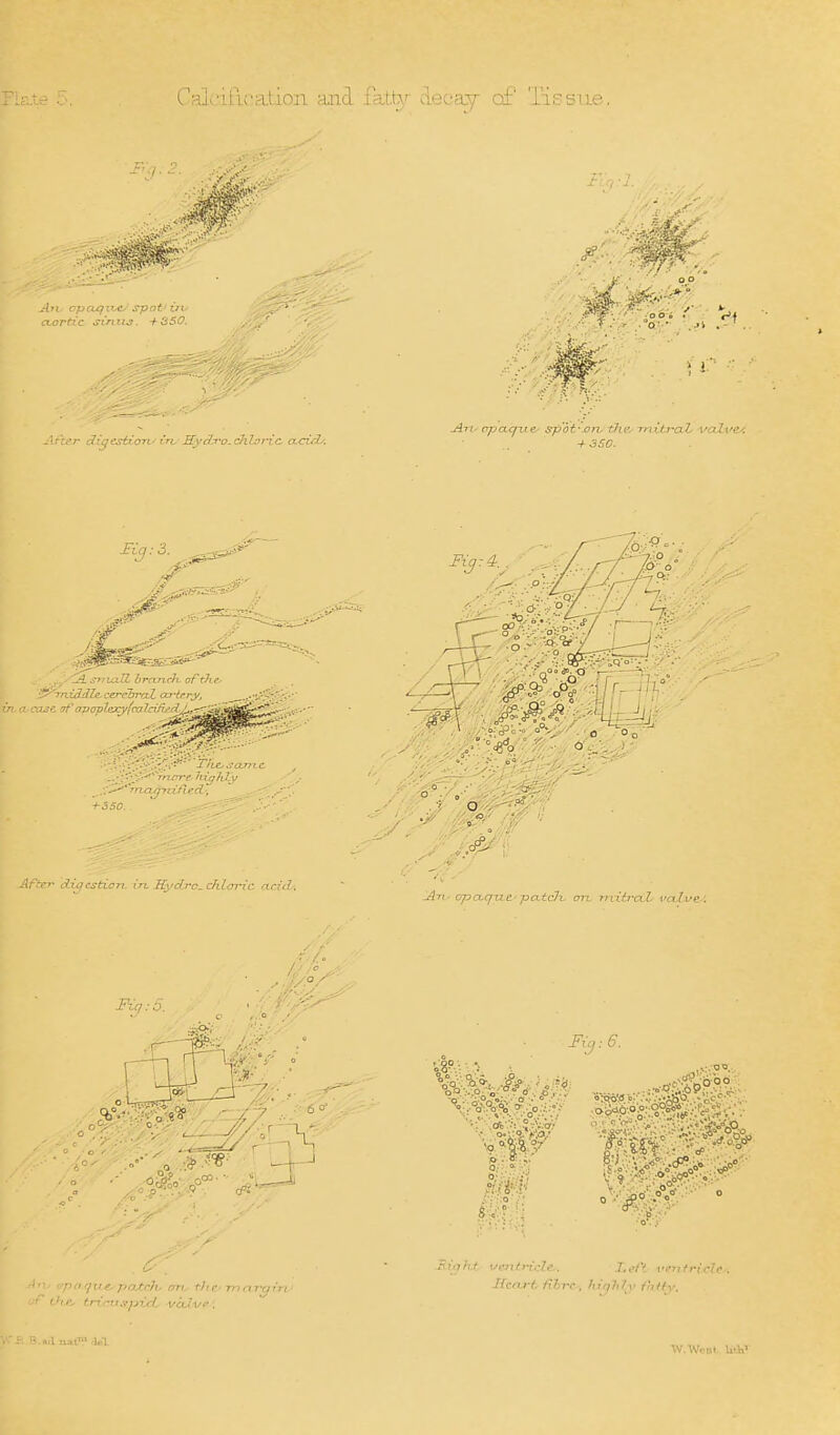 Rs.te 5 Calcifi-oation and fatto'- decvxv of' lis sue. T''q . 2. a,ortic si'niLS. -f-SSO. -f-360. .... - 'lA. s-znulZ drn-nch. of the^ ^ 0^'in.iddle cerc'biyxt aTfrry, a ccuse fjf ovavlexyfmla'fj.''^. - '- .-T./i-''' ThCjSCLmc _■-*;-' rn/rre- hxq7i7 v o . diacsticri i'l, HydTc^ chloric ncid. SO ■ r ■ pcLtrh' on. the rn,ti'cj^'ri ^i^ht i/eritj-j-cZ^. l^eft ventricle. Ilcfu-t fihrc-, /u^7;?y ^n/fv. »d aal™ dpt.