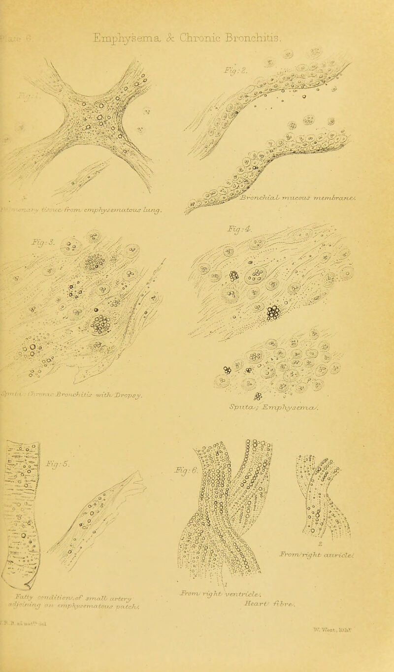 Empliysema, Sz. Chi'onic Bronchitis . \ Spi-<t'l !T::-nin,- .BTunchitis with. I>Tops </. MM ■A'.n. 9 ■ • Ffom.'ri(jht axiricle. hWllv '•'■nditioru.af small/ artery '-niplLy.ieniatoii^ pc(.(c!u Sivniy rxijht/ ventricle: W.Wral.liihV