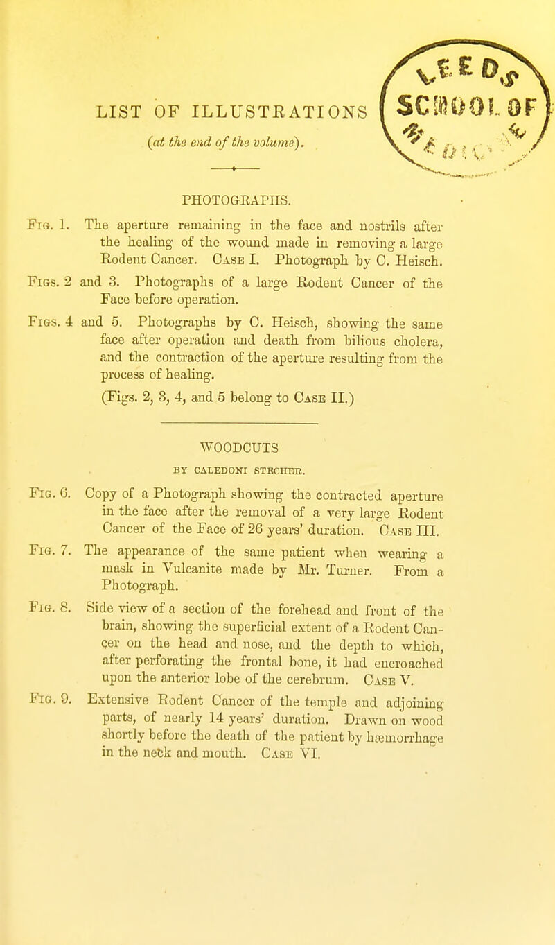 LIST OF ILLUSTRATIONS {(it ths end of the volume). PHOTOGRAPHS. Fig. 1. The aperture remaining in the face and nostrils after the healing of the wound made in removing a large Rodent Cancer. Case I. Photograph by C. Heisch. Figs. 2 and 3. Photographs of a large Rodent Cancer of the Face before operation. Figs. 4 and 5. Photographs by C. Heisch, showing the same face after operation and death from bilious cholera, and the contraction of the apertui-e resulting from the process of healing. (Figs. 2, 3, 4, and 5 belong to Case II.) WOODCUTS BY CALEDONI STECHEE. Fig. 6. Copy of a Photograph showing the contracted apertui-e in the face after the removal of a very large Rodent Cancer of the Face of 26 years' duration. Case III. Fig. 7. The appearance of the same patient when wearing a mask in Vulcanite made by Mr. Turner. From a Photograph. Fig. 8, Side ^dew of a section of the forehead and front of the brain, showing the superficial extent of a Rodent Can- Qer on the head and nose, and the depth to which, after perforating the frontal bone, it had encroached upon the anterior lobe of the cerebrum. Case V. Fig. 9. Extensive Rodent Cancer of the temple and adjoining parts, of nearly 14 years' duration. Drawn on wood shortly before the death of the patient by hasmorrhage in the netk and mouth. Case VI.