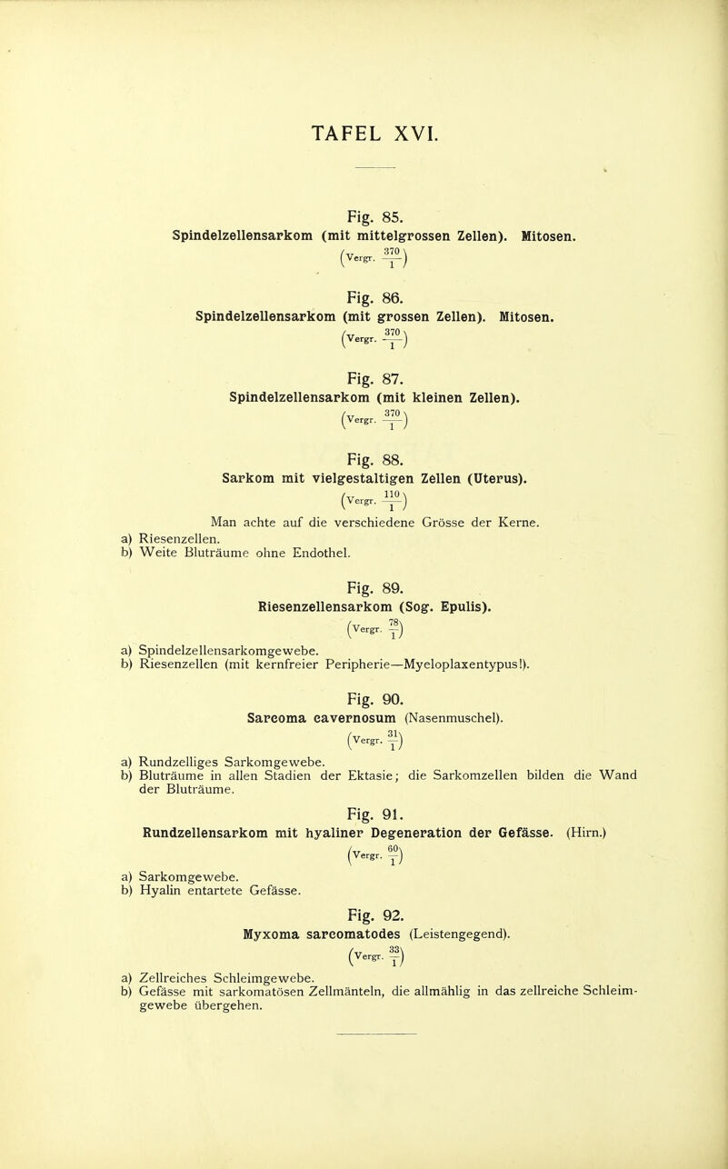 Fig. 85. Spindelzellensarkom (mit mittelgrossen Zellen). Mitosen. (vergr. -3|°) Fig. 86. Spindelzellensarkom (mit grossen Zellen). Mitosen. Fig. 87. Spindelzellensarkom (mit kleinen Zellen). (verg, ») Fig. 88. Sarkom mit vielgestaltigen Zellen (Uterus). (Ver^. ™ ) Man achte auf die verschiedene Grösse der Kerne. a) Riesenzellen. b) Weite Bluträume ohne Endothel. Fig. 89. Riesenzellensarkom (Sog. Epulis). (Vergr. ™) a) Spindelzellensarkomgewebe. b) Riesenzellen (mit kernfreier Peripherie—Myeloplaxentypus!). Fig. 90. Sareoma eavernosum (Nasenmuschel). (verg, ») a) Rundzelliges Sarkomgewebe. b) Bluträume in allen Stadien der Ektasie; die Sarkomzellen bilden die Wand der Bluträume. Fig. 91. Rundzellensarkom mit hyaliner Degeneration der Gefässe. (Hirn.) (Verg, £) a) Sarkomgewebe. b) Hyalin entartete Gefässe. Fig. 92. Myxoma sarcomatodes (Leistengegend). (vergr. f) a) Zellreiches Schleimgewebe. b) Gefässe mit sarkomatösen Zellmänteln, die allmählig in das zellreiche Schleim- gewebe übergehen.