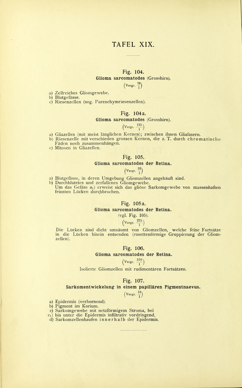Fig. 104. Glioma sarcomatodes (Grosshirn). (Verg, ™) a) Zellreiches Gliomgewebe. b) Blutgefässe. c) Riesenzellen (sog. Parenchymriesenzellen). Fig. 104 a. Glioma sarcomatodes (Grosshirn). (vergr. ») a) Gliazellen (mit meist länglichen Kernen); zwischen ihnen Gliafasern. b) Riesenzelle mit verschieden grossen Kernen, die z.T. durch chromatische Fäden noch zusammenhängen. c) Mitosen in Gliazellen. Fig. 105. Glioma sarcomatodes der Retina. (v«gr. ») a) Blutgefässe, in deren Umgebung Gliomzellen angehäuft sind. b) Durchblutetes und zerfallenes Gliomgewebe. Um das Gefäss ai) erweist sich das gliöse Sarkomgewebe von massenhaften feinsten Lücken durchbrochen. Fig. 105 a. Glioma sarcomatodes der Retina. (vgl. Fig. 105). (Verg, ™) Die Lücken sind dicht umsäumt von Gliomzellen, welche feine Fortsätze in die Lücken hinein entsenden (rosettenförmige Gruppierung der Gliom- zellen). Fig. 106. Glioma sarcomatodes der Retina. (Verg, »!») Isolierte Gliomzellen mit rudimentären Fortsätzen. Fig. 107. Sarkomentwiekelung in einem papillären Pigmentnaevus. (Vergr. f) a) Epidermis (verhornend). b) Pigment im Korium. c) Sarkomgewebe mit netzförmigem Stroma, bei ci) bis unter die Epidermis infiltrativ vordringend. d) Sarkomzellenhaufen innerhalb der Epidermis.