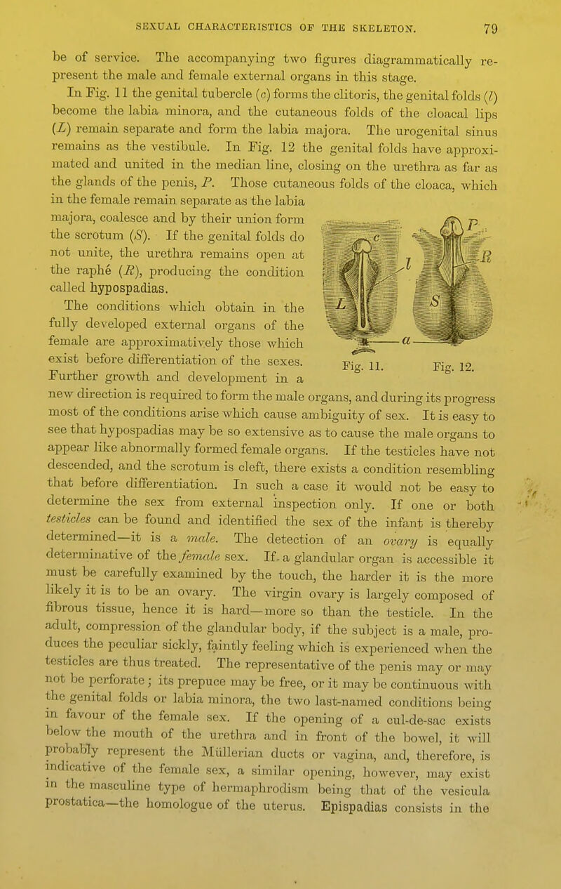 Fig. 12. be of service. The accompanying tAvo figures diagrammatically re- present the male and female external organs in this stage. In Fig. 11 the genital tubercle (c) forms the clitoris, the genital folds {I) become the labia minora, and the cutaneous folds of the cloacal lips (Z) remain separate and form the labia majora. The urogenital sinus remains as the vestibule. In Fig. 12 the genital folds have approxi- mated and united in the median line, closing on the urethra as far as the glands of the penis, F. Those cutaneous folds of the cloaca, which in the female remain separate as the labia majora, coalesce and by their union form the scrotum (S). If the genital folds do not unite, the urethra remains open at the raphe (i?), producing the condition called hypospadias. The conditions which obtain in the fully developed external organs of the female are approximatively those which exist before diiferentiation of the sexes. Further growth and development in a new direction is required to form the male organs, and during its progress most of the conditions arise which cause ambiguity of sex. It is easy to see that hypospadias may be so extensive as to cause the male organs to appear like abnormally formed female organs. If the testicles have not descended, and the scrotum is cleft, there exists a condition resembling that before differentiation. In such a case it would not be easy to determine the sex from external inspection only. If one or both testicles can be found and identified the sex of the infant is thereby determined—it is a mcde. The detection of an omry is equally determinative of the female sex. If. a glandular organ is accessible it must be carefully examined by the touch, the harder it is the more likely it is to be an ovary. The virgin ovary is largely composed of fibrous tissue, hence it is hard—more so than the testicle. In the adult, compression of the glandular body, if the subject is a male, pro- duces the peculiar sickly, faintly feeling which is experienced when the testicles are thus treated. The representative of the penis may or may not be perforate; its prepuce may be free, or it may be continuous with the genital folds or labia minora, the two last-named conditions being in favour of the female sex. If the opening of a cul-de-sac exists below the mouth of the urethra and in front of the bowel, it will probably represent the Miillerian ducts or vagina, and, therefore, is indicative of the female sex, a similar opening, however, may exist in the masculine type of hermaphrodism being tliat of the vesicula prostatica—the homologue of the uterus. Epispadias consists in the