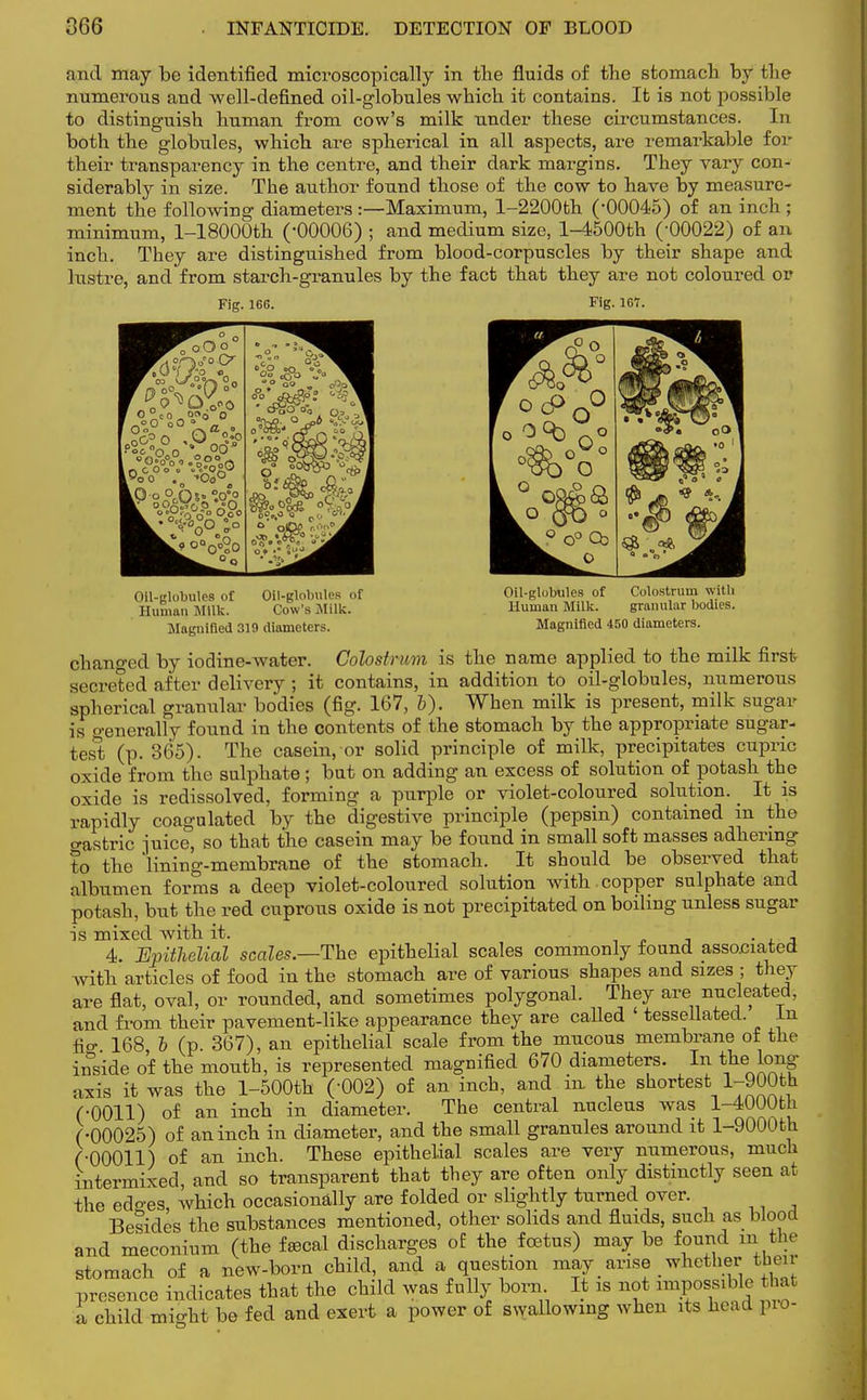 and may be identified microscopically in the fluids of the stomach by the numerous and well-defined oil-globules which it contains. It is not possible to distinguish human from cow's milk under these circumstances. In both the globules, which are spherical in all aspects, are remarkable for their transparency in the centre, and their dark margins. They vary con- siderably in size. The author found those of the cow to have by measure- ment the following diameters :—Maximum, l-2200th (-00045) of an inch ; minimum, l-18000th (-00006) ; and medium size, l-4500th (-00022) of an inch. They are distinguished from blood-corpuscles by their shape and lustre, and from starch-granules by the fact that they are not coloured or Fig. 166. Fig. 167. Oil-globules of Human Milk. Oil-globules of Cow's Milk. Oil-globules of Human Milk Magnified 319 diameters. Colostrum with granular bodies. Magnified 450 diameters. changed by iodine-water. Colostrum is the name applied to the milk first secreted after delivery ; it contains, in addition to oil-globules, numerous spherical granular bodies (fig. 167, 6). When milk is present, milk sugar is generally found in the contents of the stomach by the appropriate sugar- test (p. 365). The casein, or solid principle of milk, precipitates cupric oxide from the sulphate; but on adding an excess of solution of potash the oxide is redissolved, forming a purple or violet-coloured solution. It is rapidly coagulated by the digestive principle (pepsin) contained in the o-astric juice, so that the casein may be found in small soft masses adhering to the lining-membrane of the stomach. It should be observed that albumen forms a deep violet-coloured solution with , copper sulphate and potash, but the red cuprous oxide is not precipitated on boiling unless sugar is mixed with it. . 4. Epithelial scales.—The epithelial scales commonly found associated with articles of food in the stomach are of various shapes and sizes ; they are flat, oval, or rounded, and sometimes polygonal. They are nucleated, and from their pavement-like appearance they are called ' tessellated. in fio- 168 b (p. 367), an epithelial scale from the mucous membrane of the inside o'f the mouth, is represented magnified 670 diameters. In the long axis it was the l-500th (-002) of an inch, and in. the shortest l-900th (-0011) of an inch in diameter. The central nucleus was l-4W0th (•00025) of an inch in diameter, and the small granules around it l-9000th (-00011) of an inch. These epithelial scales are very numerous, much intermixed, and so transparent that they are often only distinctly seen at the edo-es, which occasionally are folded or slightly turned over. Besides the substances mentioned, other solids and fluids, such as blood and meconium (the faecal discharges of the foetus) may be found ui the stomach of a new-born child, and a question may arise whether tbeir presence indicates that the child was fully born It is not impossible that a child mio-ht be fed and exert a power of swallowing when its head pro-