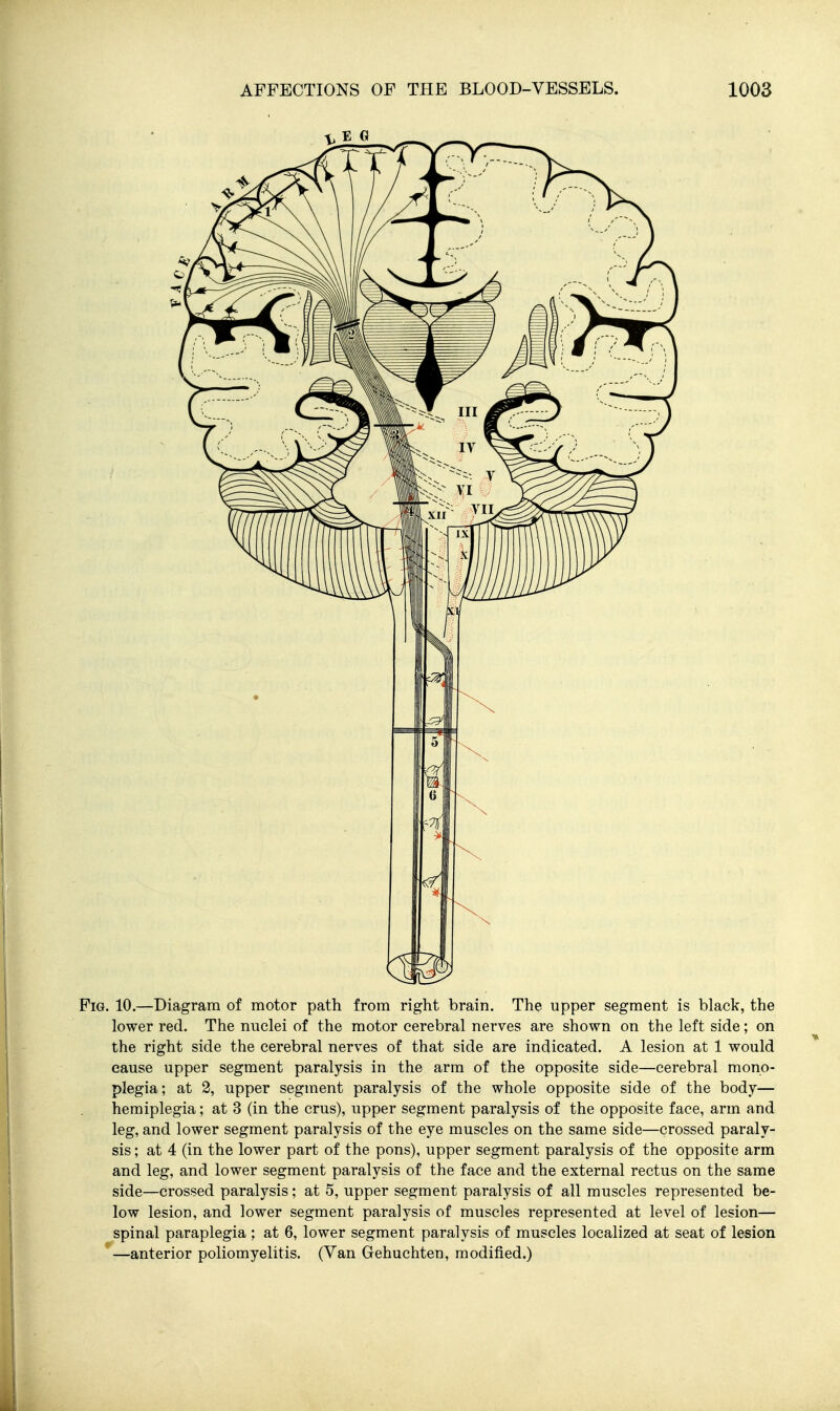 Pig. 10.—Diagram of motor path from right brain. The upper segment is black, the lower red. The nuclei of the motor cerebral nerves are shown on the left side; on the right side the cerebral nerves of that side are indicated. A lesion at 1 would cause upper segment paralysis in the arm of the opposite side—cerebral mono- plegia; at 2, upper segment paralysis of the whole opposite side of the body— hemiplegia; at 3 (in the cms), upper segment paralysis of the opposite face, arm and leg, and lower segment paralysis of the eye muscles on the same side—crossed paraly- sis ; at 4 (in the lower part of the pons), upper segment paralysis of the opposite arm and leg, and lower segment paralysis of the face and the external rectus on the same side—crossed paralysis; at 5, upper segment paralysis of all muscles represented be- low lesion, and lower segment paralysis of muscles represented at level of lesion— spinal paraplegia ; at 6, lower segment paralysis of muscles localized at seat of lesion —anterior poliomyelitis. (Van Gehuchten, modified.)