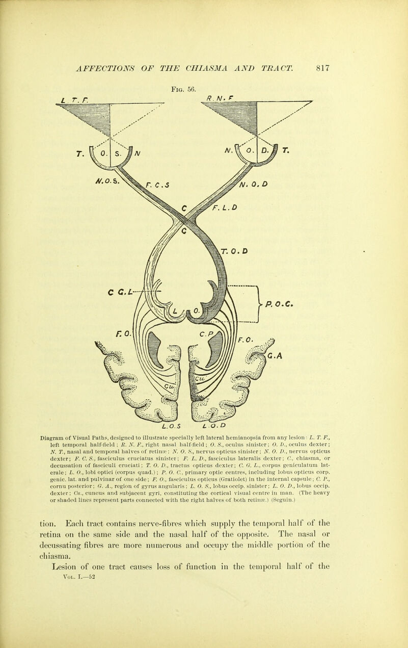 Fig. 56. L.O.S LO.D Diagram of Visual Paths, designed to illustrate specially left lateral hemianopsia from any lesion : L. T. F., left temporal half-field ; E. N. F, right nasal half-field ; 0. S., oculus sinister; 0. D., oculus dexter; N. T., nasal and temporal halves of retinae; N. 0. S., nervus opticus sinister; N. 0. £>., nervus opticus dexter; F. C. S., fasciculus cruciatus sinister; F. L. D., fasciculus lateralis dexter; C, chiasma, or decussation of fasciculi cruciati; T. 0. D., tractus opticus dexter; C. G. L., corpus geniculatum lat- erale; L. 0., lobi optici (corpus quad.); P. 0. C, primary optic centres, including lobus opticus corp. genie, lat. and pulvinar of one side ; F. 0., fasciculus opticus (Gratiolet) in the internal capsule; C. P., cornu posterior; G. A., region of gyrus angularis ; L. 0. S., lobus occip. sinister; L. 0. D., lobus occip. dexter; Cu., cuneus and subjacent gyri, constituting the cortical visual centre in man. (The heavy or shaded lines represent parts connected with the right halves of both retinpe.) (Seguin.) tion. Each tract contains nerve-fibres which supply the temporal half of the retina on the same side and the nasal half of the opposite. The nasal or decussating fibres are more numerous and occupy the middle portion of the chiasma. Lesion of one tract causes loss of function in the temporal half of the Vol. I.—52