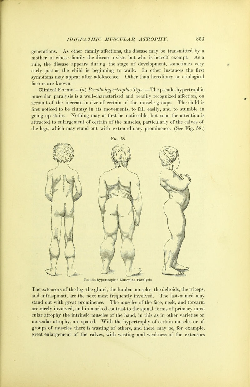 generations. As other family affections, the disease may be transmitted by a mother in whose family the disease exists, but who is herself exempt. As a rule, the disease appears during the stage of development, sometimes very early, just as the child is beginning to walk. In other instances the first symptoms may appear after adolescence. Other than hereditary no etiological factors are known. Clinical Forms.—(a) Pseudo-hypertropMc Type.—The pseudo-hypertrophic muscular paralysis is a well-characterized and readily recognized affection, on account of the increase in size of certain of the muscle-groups. The child is first noticed to be clumsy in its movements, to fall easily, and to stumble in going up stairs. Nothing may at first be noticeable, but soon the attention is attracted to enlargement of certain of the muscles, particularly of the calves of the legs, which may stand out with extraordinary prominence. (See Fig. 58.) Fig. 58. Pseudo-hypertrophic Muscular Paralysis. The extensors of the leg, the glutei, the lumbar muscles, the deltoids, the triceps, and infraspinati, are the next most frequently involved. The last-named may stand out with great prominence. The muscles of the face, neck, and forearm are rarely involved, and in marked contrast to the spinal forms of primary mus- cular atrophy the intrinsic muscles of the hand, in this as in other varieties of muscular atrophy, are spared. With the hypertrophy of certain muscles or of groups of muscles there is wasting of others, and there may be, for example, great enlargement of the calves, with wasting and weakness of the extensors