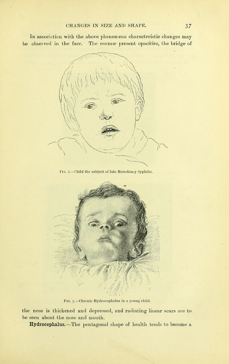In association with the above phenomena characteristic changes may be obseived in the face. The cornese present opacities, the bridge of Fis. 5.—Child the subject of late Hereditary Syphilis. Fig. 7.—Chronic Hydrocephalus in a young child. the nose is thickened and depressed, and radiating linear scars are to be seen about the nose and mouth. Hydrocephalus.—The pentagonal shape of health tends to become a