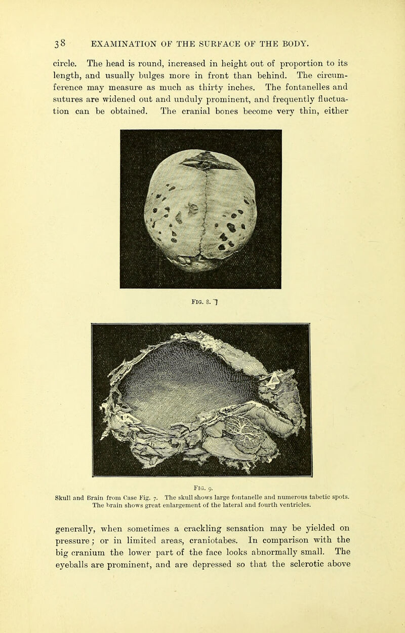 circle. The head is round, increased in height out of proportion to its length, and usually bulges more in front than behind. The circum- ference may measure as much as thirty inches. The fontanelles and sutures are widened out and unduly prominent, and frequently fluctua- tion can be obtained. The cranial bones become very thin, either Fig. 9. Skull and Brain from Case Mg. 7. The skull shows large fontanelle and numerous tabetic spots. The brain shows great enlargement of the lateral and fourth ventricles. generally, when sometimes a crackling sensation may be yielded on pressure; or in limited areas, craniotabes. In comparison with the big cranium the lower part of the face looks abnormally small. The eyeballs are prominent, and are depressed so that the sclerotic above