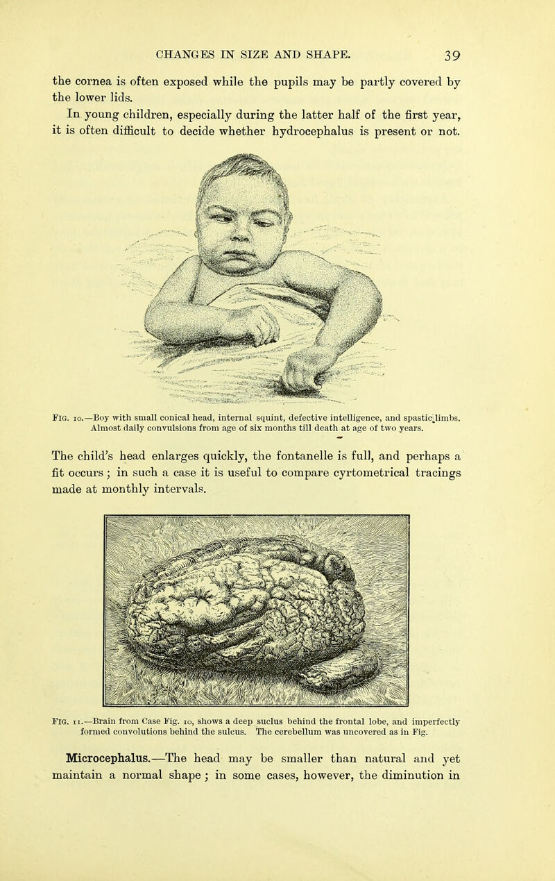 the cornea is often exposed while the pupils may be partly covered by the lower lids. In young children, especially during the latter half of the first year, it is often difficult to decide whether hydrocephalus is present or not. Fig. io.—Boy with small conical head, internal squint, defective intelligence, and spastic.limbs. Almost daily convulsions from age of six months till death at age of two years. The child's head enlarges quickly, the fontanelle is full, and perhaps a fit occurs; in such a case it is useful to compare cyrtometrical tracings made at monthly intervals. Fig. ii.—Brain from Case Fig. io, shows a deep suclus behind the frontal lobe, and imperfectly formed convolutions behind the sulcus. The cerebellum was uncovered as in Fig. Microcephalus.—The head may be smaller than natural and yet maintain a normal shape ; in some cases, however, the diminution in