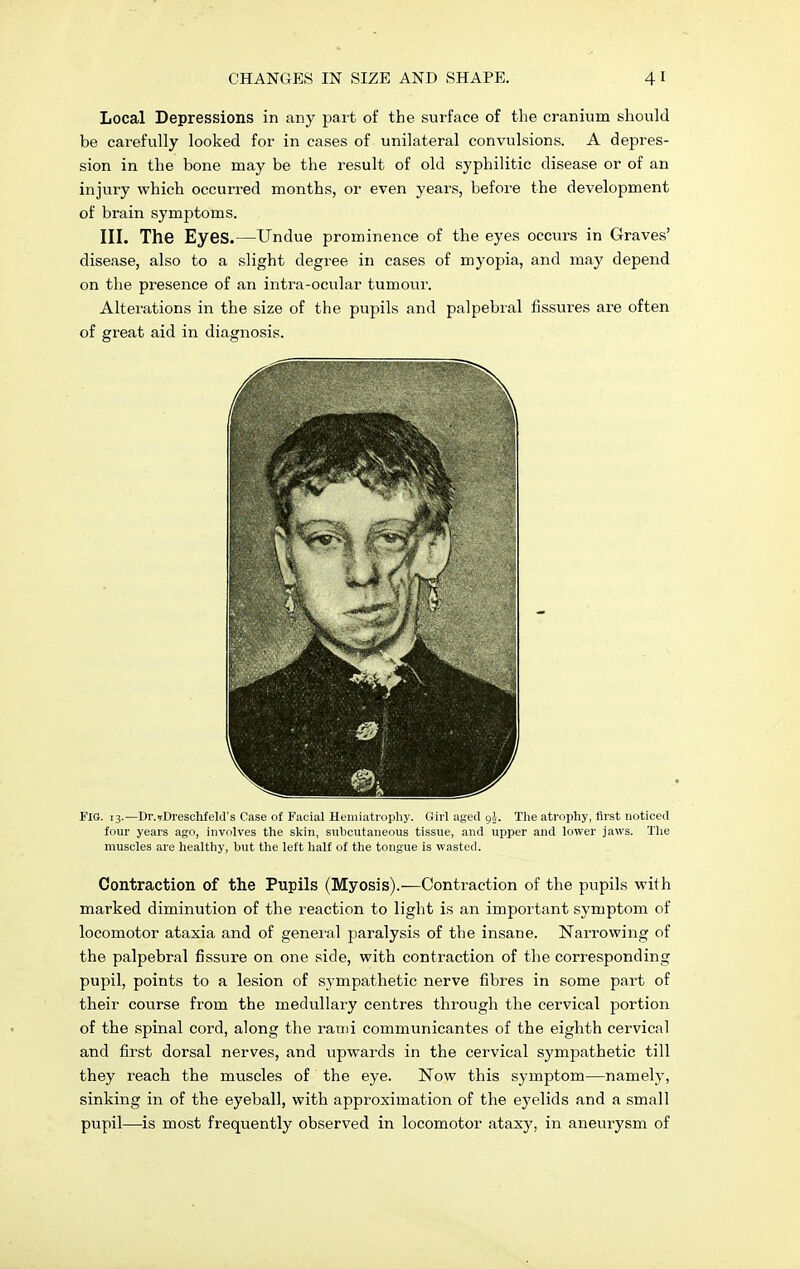 Local Depressions in any part of the surface of the cranium should be carefully looked for in cases of unilateral convulsions. A depres- sion in the bone may be the result of old syphilitic disease or of an injury which occurred months, or even years, before the development of brain symptoms. III. The Eyes.—Undue prominence of the eyes occurs in Graves' disease, also to a slight degree in cases of myopia, and may depend on the presence of an intra-ocular tumour. Alterations in the size of the pupils and palpebral fissures are often of great aid in diagnosis. FIG. 13.—Dr.?Dreschfeld's Case of Facial Hemiatrophy. Girl aged gj. The atrophy, first noticed four years ago, involves the skin, subcutaneous tissue, and upper and lower jaws. The muscles are healthy, but the left half of the tongue is wasted. Contraction of the Pupils (Myosis).—Contraction of the pupils with marked diminution of the reaction to light is an important symptom of locomotor ataxia and of general paralysis of the insane. Narrowing of the palpebral fissure on one side, with contraction of the corresponding pupil, points to a lesion of sympathetic nerve fibres in some part of their course from the medullary centres through the cervical portion of the spinal cord, along the rami communicantes of the eighth cervical and first dorsal nerves, and upwards in the cervical sympathetic till they reach the muscles of the eye. Now this symptom—namely, sinking in of the eyeball, with approximation of the eyelids and a small pupil—is most frequently observed in locomotor nt&xy, in aneurysm of