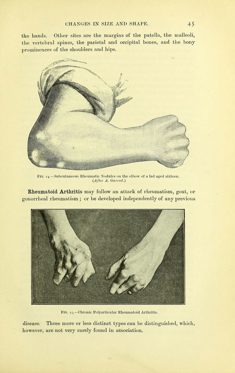 the hands. Other sites are the margins of the patella, the malleoli, the vertebral spines, the parietal and occipital bones, and the bony prominences of the shoulders and hips. Fig. 14.—Subcutaneous Rheumatic Nodules on the elbow of a lad aged sixteen. (After A. Garrod.) Rheumatoid Arthritis may follow an attack of rheumatism, gout, or gonorrheal rheumatism ; or be developed independently of any previous Fig. 15.—Chronic Polyarticular Rheumatoid Arthritis. disease. Three more or less distinct types can be distinguished, which, however, are not very rarely found in association.