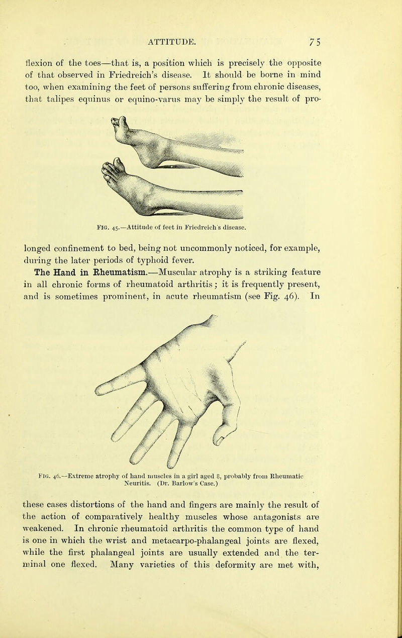 liexion of the toes—that is, a position which is precisely the opposite of that observed in Friedreich's disease. It should be borne in mind too, when examining the feet of persons suffering from chronic diseases, that talipes equinus or equino-varus may be simply the result of pro- FIG. 45.—Attitude of feet in Friedreich's disease. longed confinement to bed, being not uncommonly noticed, for example, during the later periods of typhoid fever. The Hand in Rheumatism.—Muscular atrophy is a striking feature in all chronic forms of rheumatoid arthritis; it is frequently present, and is sometimes prominent, in acute rheumatism (see Fig. 46). In Fig. 46.—Extreme atrophy of hand muscles in a girl aged 8, probably from Rheumatic Neuritis. (Dr. Barlow's Case.) these cases distortions of the hand and fingers are mainly the result of the action of comparatively healthy muscles whose antagonists are weakened. In chronic rheumatoid arthritis the common type of hand is one in which the wrist and metacarpo-phalangeal joints are flexed, while the first phalangeal joints are usually extended and the ter- minal one flexed. Many varieties of this deformity are met with,