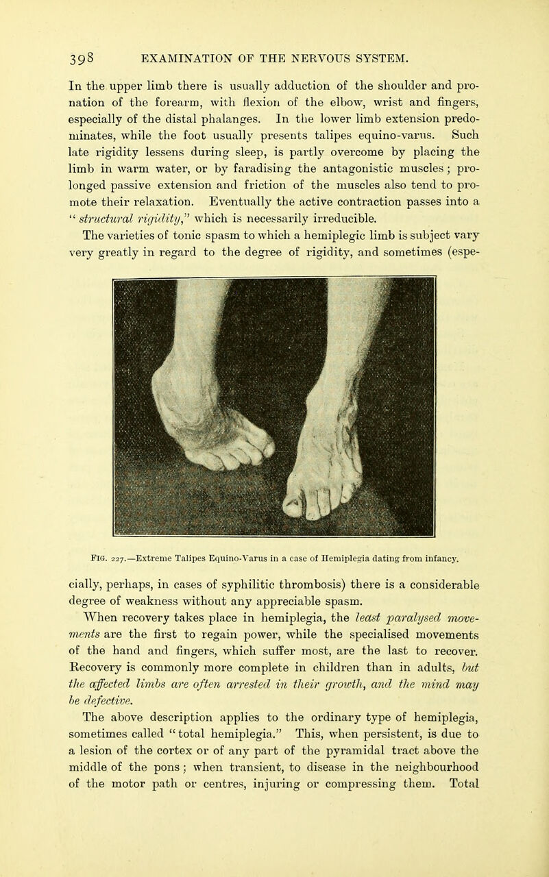 In the upper limb there is usually adduction of the shoulder and pro- nation of the forearm, with flexion of the elbow, wrist and fingers, especially of the distal phalanges. In the lower limb extension predo- minates, while the foot usually presents talipes equino-varus. Such late rigidity lessens during sleep, is partly overcome by placing the limb in warm water, or by faradising the antagonistic muscles ; pro- longed passive extension and friction of the muscles also tend to pro- mote their relaxation. Eventually the active contraction passes into a 11 structural rigidity,'' which is necessarily irreducible. The varieties of tonic spasm to which a hemiplegic limb is subject vary very greatly in regard to the degree of rigidity, and sometimes (espe- FlG. 227.—Extreme Talipes Equino-Varus in a case of Hemiplegia dating from infancy. cially, perhaps, in cases of syphilitic thrombosis) there is a considerable degree of weakness without any appreciable spasm. When recovery takes place in hemiplegia, the least paralysed move- ments are the first to regain power, while the specialised movements of the hand and fingers, which suffer most, are the last to recover. Recovery is commonly more complete in children than in adults, but the affected limbs are often arrested in their growth, and the mind may be defective. The above description applies to the ordinary type of hemiplegia, sometimes called  total hemiplegia. This, when persistent, is due to a lesion of the cortex or of any part of the pyramidal tract above the middle of the pons; when transient, to disease in the neighbourhood of the motor path or centres, injuring or compressing them. Total