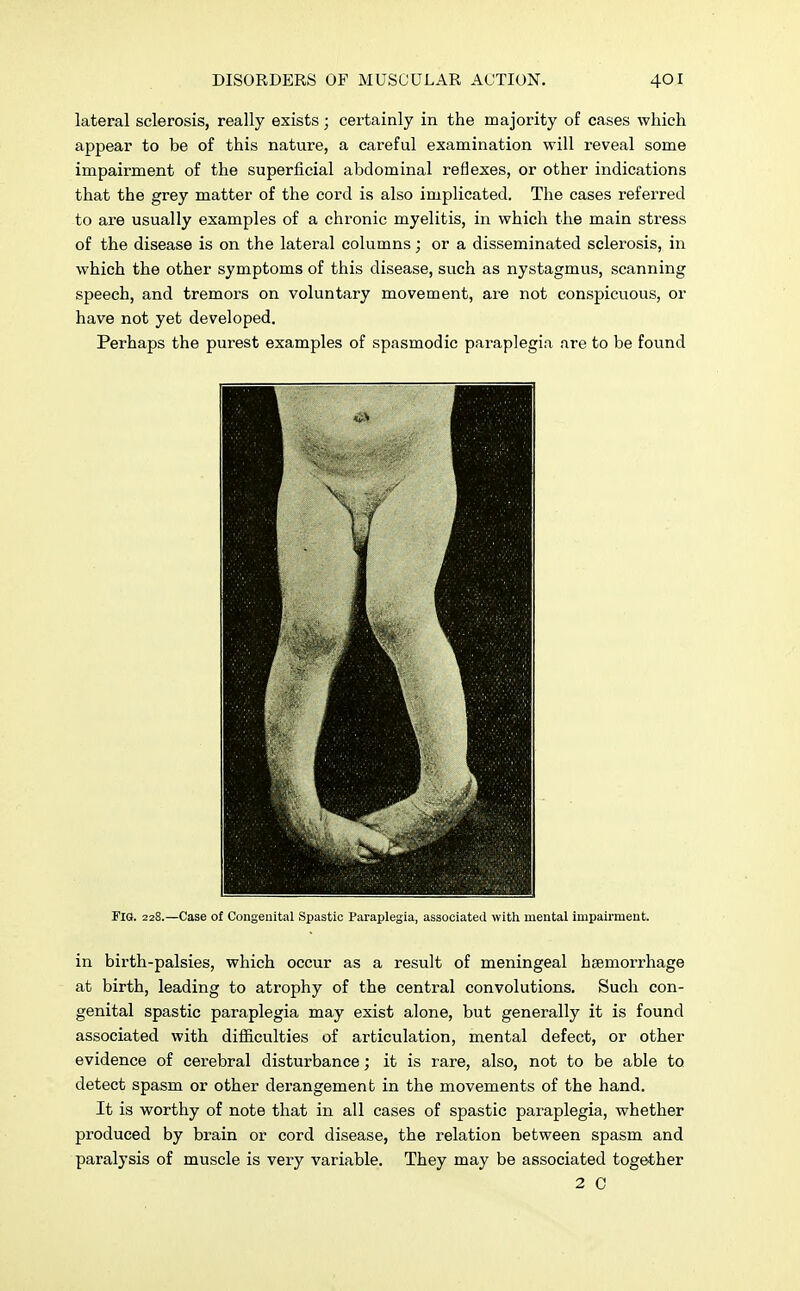 lateral sclerosis, really exists; certainly in the majority of cases which appear to be of this nature, a careful examination will reveal some impairment of the superficial abdominal reflexes, or other indications that the grey matter of the cord is also implicated. The cases referred to are usually examples of a chronic myelitis, in which the main stress of the disease is on the lateral columns; or a disseminated sclerosis, in which the other symptoms of this disease, such as nystagmus, scanning speech, and tremors on voluntary movement, are not conspicuous, or have not yet developed. Perhaps the purest examples of spasmodic paraplegia are to be found FIG. 228.—Case of Congenital Spastic Paraplegia, associated with mental impairment. in birth-palsies, which occur as a result of meningeal haemorrhage at birth, leading to atrophy of the central convolutions. Such con- genital spastic paraplegia may exist alone, but generally it is found associated with difficulties of articulation, mental defect, or other evidence of cerebral disturbance; it is rare, also, not to be able to detect spasm or other derangement in the movements of the hand. It is worthy of note that in all cases of spastic paraplegia, whether produced by brain or cord disease, the relation between spasm and paralysis of muscle is very variable. They may be associated together 2 C