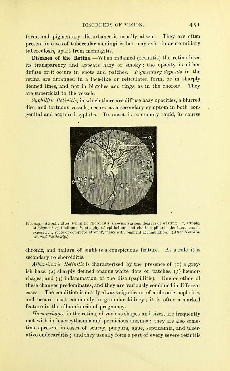 form, and pigmentary disturbance is usually absent. They are often present in cases of tubercular meningitis, but may exist in acute miliary tuberculosis, apart from meningitis. Diseases of the Retina.—When inflamed (retinitis) the retina loses its transparency and appears hazy or smoky; the opacity is either- diffuse or it occurs in spots and patches. Pigmentary deposits in the retina are arranged in a lace-like or reticulated form, or in sharply defined lines, and not in blotches and rings, as in the choroid. They are superficial to the vessels. Syphilitic Retinitis, in which there are diffuse hazy opacities, a blurred disc, and tortuous vessels, occurs as a secondary symptom in both con- genital and acquired syphilis. Its onset is commonly rapid, its course Fig. 249.—Atrophy after Syphilitic Choroiditis, showing various degrees of wasting, a, atrophy of pigment epithelium; b, atrophy of epithelium and chorio-capillaris, the large vessels exposed ; c, spots of complete atrophy, many with pigment accumulation. (After Hutchin- son and Nettleship.) chronic, and failure of sight is a conspicuous feature. As a rule it is secondary to choroiditis. Albuminuric Retinitis is characterised by the presence of (1) a grey- ish haze, (2) sharply defined opaque white dots or patches, (3) haemor- rhages, and (4) inflammation of the disc (papillitis). One or other of these changes predominates, and they are variously combined in different cases. The condition is nearly always significant of a chronic nephritis, and occurs most commonly in granular kidney; it is often a marked feature in the albuminuria of pregnancy. Hcemorrhages in the retina, of various shapes and sizes, are frequently met with in leucocythsemia and pernicious anaemia; they are also some- times present in cases of scurvy, purpura, ague, septicaemia, and ulcer- ative endocarditis ; and they usually form a part of every severe retinitis