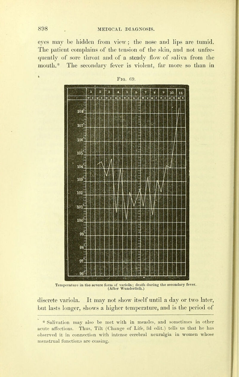 eyes may be hidden from view; tlie nose and lips are tumid. The patient complains of the tension of the skin, and not unfre- quently of sore throat and of a steady flow of saliva from the mouth.* The secondary fever is violent, far more so than in Fig. 69. HI DBDIIDBIBBDIira IBDBQBDQDQDBOBDBDBDIIDBI ■1 1 II 1 ■ 1 1 1 II 11 III 11 III mil III ■III II 1 1 1 Hi 1 ■ 1 1 1 1 1 II Ml 1 III II mi II 1 1 1 1 1 I HI II 1 1 1 II 1 HI 1 KUI HI 1 I 1 1 1 Hi 1 1 1 1 II 1 HI 1 III II 1 H 1 1 1 Hi n ■ 1 1 s 1 11 1 II 1 in II H 1 1 Hi i 1 1 11 i 1 im II M 1 li Hi II 1 1 ■ HI i HH 1 1 1 1 11 H 1 1 1 1 i n 11 HI 1 1 1 1 ■ 1 1 1 1 II i 1 1 1 1 1 H 1 1 1 1 II 1 1 III II 1 1 1 1 Hi II 1 1 1 II 1 1 III II 1 1 1 1 Hi 1 1 1 1 II 1 II III II 1 1 1 1 H 1 1 1 II n H III III n 1 1 1 Temperature in the severe form of variola; tieutli during the secondary fever. (After Wunderlich.) discrete variola. It may not show itself until a day or two later, but lasts longer, shows a higher temperature, and is the period of * Salivation may also be met with in measles, and sometimes in other acute affections. Thus, Tilt (Change of Life, 3d edit.) tells us that he has observed it in connection with intense cerebral neuralgia in women whose menstrual functions are ceasing.