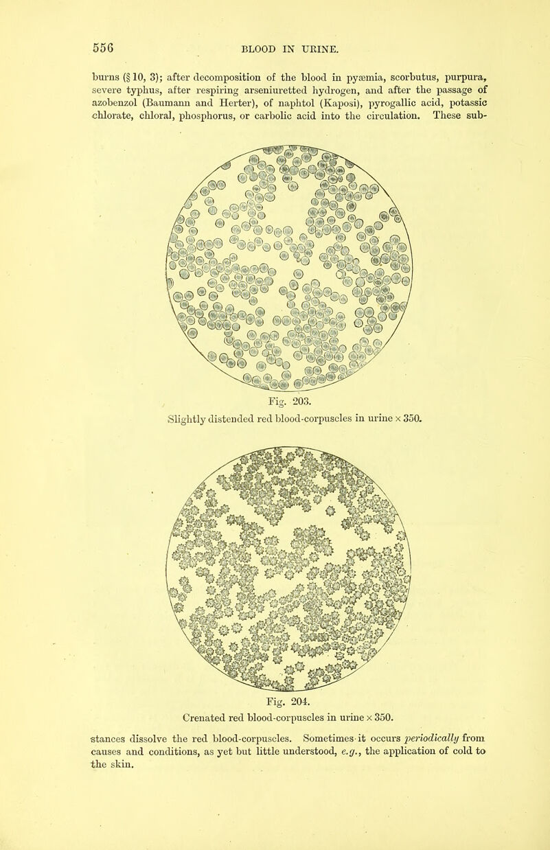 burns (§10, 3); after decomposition of the blood in pyaemia, scorbutus, purpura, severe typhus, after respiring arseniuretted hydrogen, and after the passage of azobenzol (Baumann and Herter), of naphtol (Kaposi), pyrogallic acid, potassic chlorate, chloral, phosphorus, or carbolic acid into the circulation. These sub- Fig. 203. Slightly distended red blood-corpuscles in urine x 350. Fig. 204. Crenated red blood-corpuscles in urine x 350. stances dissolve the red blood-corpuscles. Sometimes'it occurs periodically from causes and conditions, as yet but little understood, e.g., the application of cold to the skin.