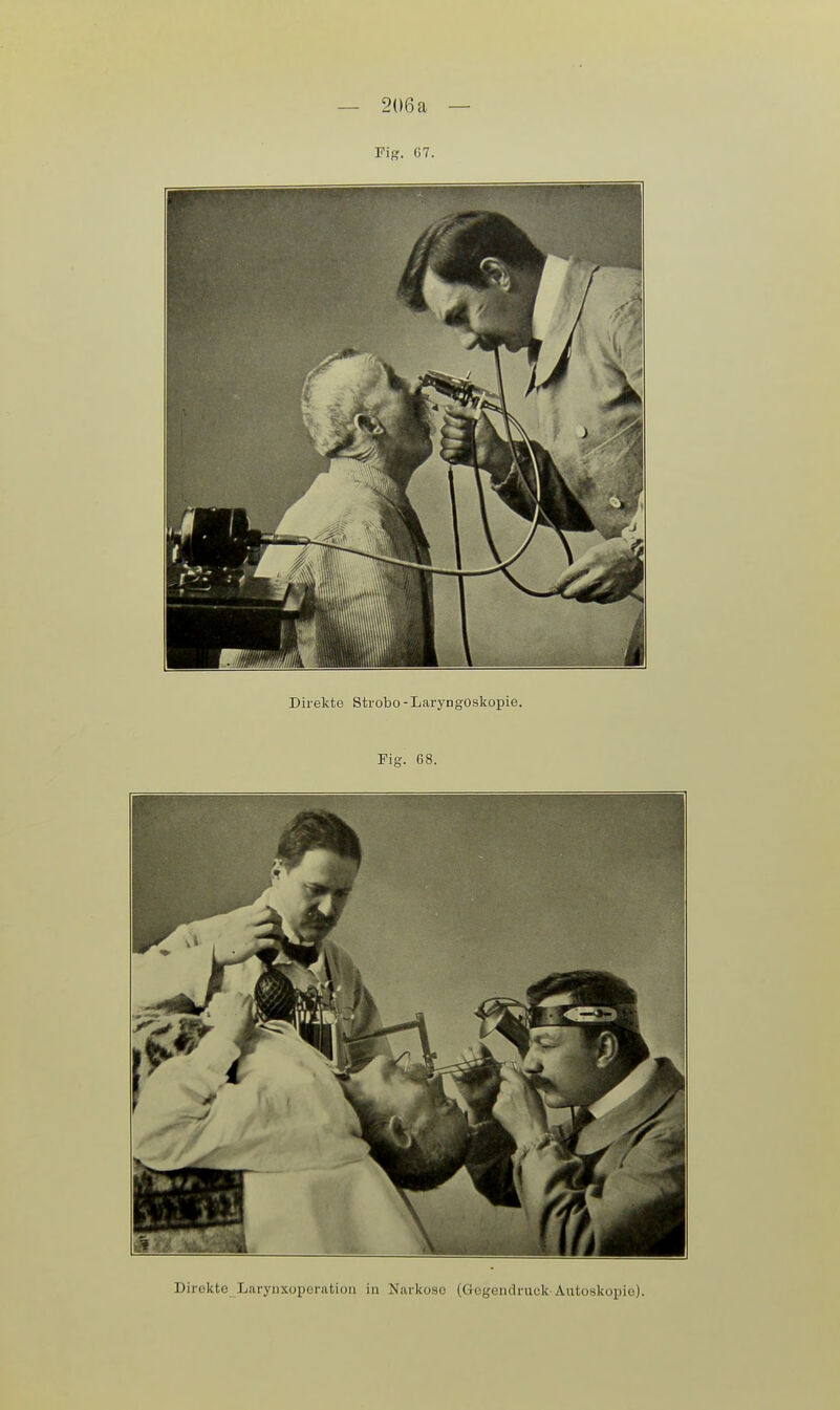 — 206a — Fig. 67. Direkte Strobo-Laryngoskopie. Fig. 68. Direkte Larynxoperatioii in Narkose (Gegendruck-Autoskopie).
