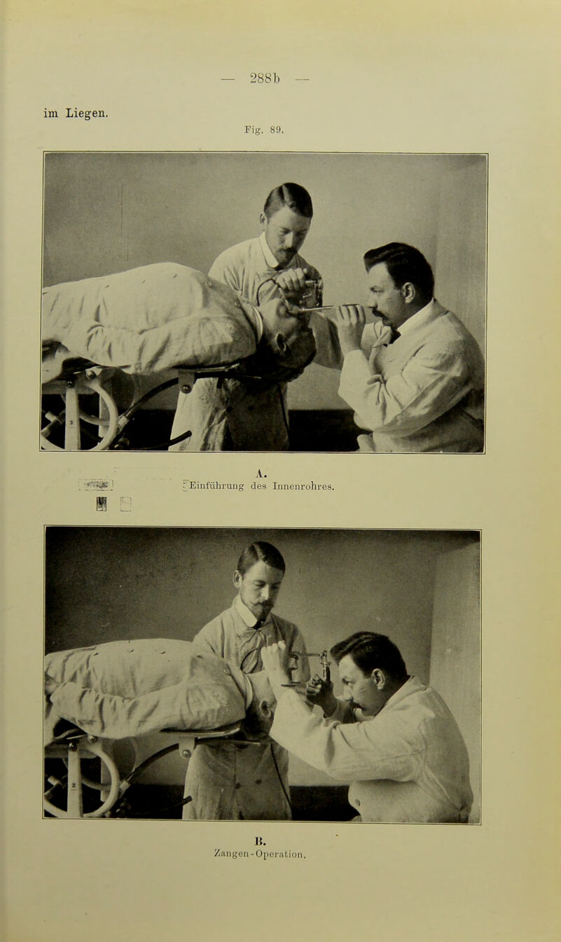 im Liegen. Fig. 89. B. Zangen-Operation.