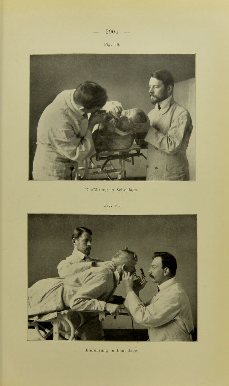 Fig. 90. Einführung in Seitenlage. Fig. 91. Einführung in Bauchlage.