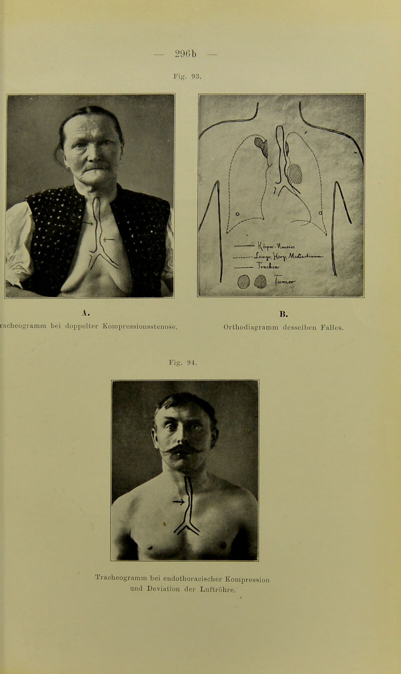 — 296b — Tracheogramm bei endothoi acischer Kompression und Deviation der Luftröhre,