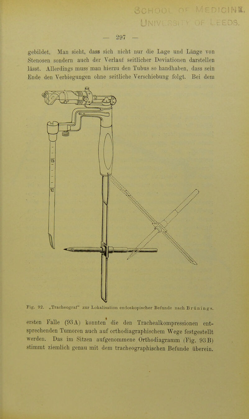 gebildet. Man sieht, dass sich nicht nur die Lage und Länge von Stenosen sondern auch der Verlauf seitlicher Deviationen darstellen lässt. Allerdings muss mau hierzu den Tubus so handhaben, dass sein Ende den Verbiegungen ohne seitliche Verschiebung folgt. Bei dem Fig. 92. „Tracheograf zur Lokalisation endoskopischer Befunde nach Brünings. ersten Falle (93 A) konnten* die den Trachealkompressionen ent- sprechenden Tumoren auch auf orthodiagraphischem Wege festgestellt werden. Das im Sitzen aufgenommene Orthodiagramm (Fig. 93 B) stimmt ziemlich genau mit dem tracheographischen Befunde überein.
