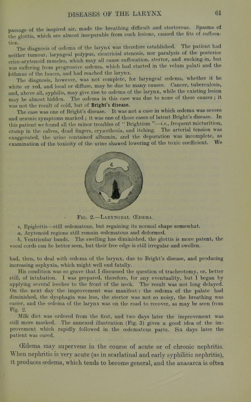 passage of the inspired air, made the breathing difficult and stertorous. Spasms of the glottis, which are almost inseparable from such lesions, caused the fits of suffoca- ^^°^The diagnosis of oedema of the larynx was therefore estabhshed. The patient had neither tumour, laryngeal polypus, cicatricial stenosis, nor paralysis of the posterior crico-arytenoid muscles, which may all cause suffocation, stertor, and sucking-in, but was suffering from progressive cedema, wliich had started in the velum palati and the isthmus of the fauces, and had reached the larynx. The diagnosis, however, was not complete, for laryngeal cedema, whether it bo white or red, and local or diffuse, may be due to many causes. Cancer, tuberculosis, and, above all, syphilis, may give rise to oedema of the larynx, while the existing lesion may be almost hidden. The oedema in this case was due to none of these causes ; it was not the result of cold, but of Blight's disease. The case was one of Bright's disease. It was not a case m which oedema was severe and ur^emic symptoms marked ; it was one of those cases of latent Bright's disease. In this patient we found all the mmor troubles of Brightism —i.e., frequent micturition, cramp in the calves, dead fingers, cryjesthesia, and itching. The arterial tension was exaggerated, the urine contained albumin, and the depuration was incomplete, as examination of the toxicity of the urme showed lowering of the toxic coefficient. We Fig. 2.—LakYxN^.eal CEdema. c, Epiglottis—still cedematous, but regainmg its normal shape somewhat, a. Arytenoid regions still remain cedematous and deformed. h. Ventricular bands. The swelling has diminished, the glottis is more patent, the vocal cords can be better seen, but their free edge is still irregular and swollen. had, then, to deal with oedema of the larynx, due to Bright's disease, and producing increasing asphyxia, which might well end fatally. His condition was so grave that I discussed the question of tracheotomy, or, better still, of intubation. I was prepared, therefore, for any eventuality, but I began by applying several leeches to the front of the neck. The result was not long delayed. On the next day the improvement was manifest: the oedema of the palate had diminished, the dysphagia was less, the stertor was not so noisy, the breathing was easier, and the oedema of the larynx was on the road to recover, as may be seen from Fig. 2. Milk diet was ordered from the first, and two days later the improvement was still more marked. The annexed illustration (Fig. 3) gives a good idea of the im- provement which rapidly followed in the cedematous parts. Six days later the patient was cured. (Edema may supervene in the course of acute or of chronic nephritis. When nephritis is very acute (as in scarlatinal and early syphilitic nephritis), it produces cedema, which tends to become general, and the anasarca is often