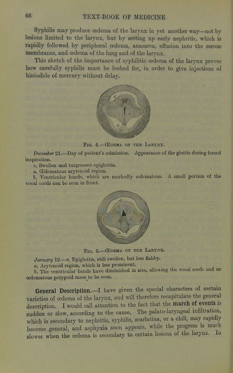 Syphilis may produce cedema of the larynx in yet another way—not by lesions limited to the laryiix, but by setting up early nephritis, which is rapidly followed by peripheral oedema, anasarca, effusion into the serous membranes, and oedema of the lung and of the larynx. This sketch of the importance of syphilitic oedema of the larynx proves how carefully syphilis must be looked for, in order to give injections of biniodide of mercury without delay. Fia. 4.—GJdema of the Labynx. December 21.—Day of patient's admission. Appearance of the glottis during forced inspiration. e. Swollen and turgescent epiglottis. a, (Edematous arytenoid region. 6, Ventricular bands, wliich are markedly oedematous. A small portion of the vocal cords can be seen in front. ■piG, 5.—(Edema of the Larynx. January 12.—e, Epiglottis, still swollen, but less flabby. a, Aiytenoid region, which is less prominent. h. The ventricular bands have diminished in size, aUowing the vocal cords and an oedematous polypoid mass to be seen. General Description.—I have given the special characters of certain varieties of oedema of the larynx, and wiU therefore recapitulate the general description. I would caU attention to the fact that the march of events is sudden or slow, according to the cause. The palato-laryngeal mfiltration, which is secondary to nephritis, syphihs, scarlatina, or a cBll, may rapidly become general, and asphyxia soon appears, wliile the progress is much slower when the oedema is secondary to certain lesions of the larynx. In