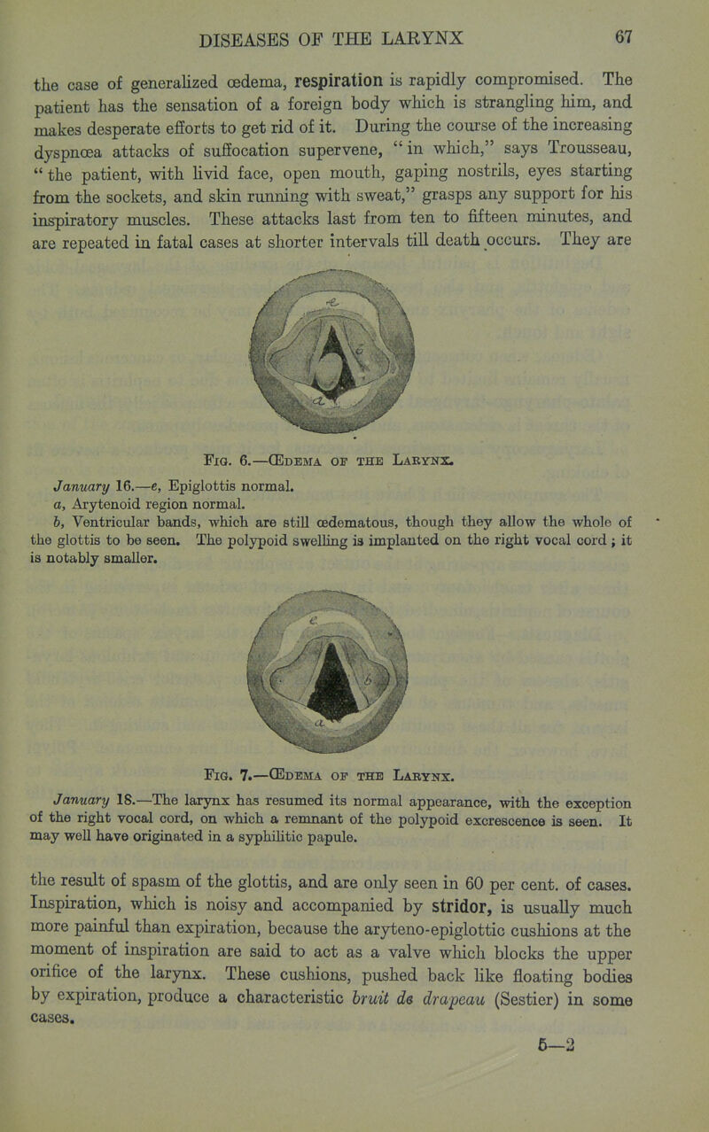 the case of generalized oedema, respiration is rapidly compromised. The patient has the sensation of a foreign body which is strangling him, and makes desperate efforts to get rid of it. During the course of the increasing dyspnoea attacks of suffocation supervene, in which, says Trousseau,  the patient, with hvid face, open mouth, gaping nostrils, eyes starting from the sockets, and skin running with sweat, grasps any support for his inspiratory muscles. These attacks last from ten to fifteen minutes, and are repeated in fatal cases at shorter intervals till death occurs. They are Fia. 6.—CEdbma of the Larynx. January 16.—e, Epiglottis normal. a. Arytenoid region normal. 6, Ventricular bands, which are still cedematous, though they allow the whole of the glottis to be seen. The polypoid swelling is implanted on the right vocal cord; it is notably smaller. Fig. 7.—CEdema of the Larynx. January 18.—The larynx has resumed its normal appearance, with the exception of the right vocal cord, on which a remnant of the polypoid excrescence is seen. It may well have originated in a syphihtie papule. the result of spasm of the glottis, and are only seen in 60 per cent, of cases. Inspiration, which is noisy and accompanied by stridor, is usually much more painful than expiration, because the aryteno-epiglottic cushions at the moment of inspiration are said to act as a valve which blocks the upper orifice of the larynx. These cushions, pushed back like floating bodies by expiration, produce a characteristic hruit de drapeau (Sestier) in some cases. 5—2
