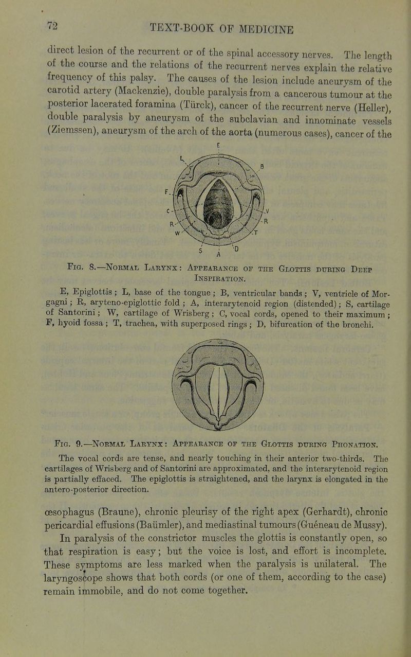 direct lesion of the recurrent or of the spinal accessory nerves. The length of the course and the relations of the recurrent nerves explain the relative frequency of this palsy. The causes of the lesion include aneurysm of the carotid artery (Mackenzie), double paralysis from a cancerous tumour at the posterior lacerated foramina (Turck), cancer of the recurrent nerve (Heller), double paralysis by aneurysm of the subclavian and innominate vessels (Ziemssen), aneurysm of the arch of the aorta (numerous cases), cancer of the Fig. 8.—^Normal Larynx: Appearance of the Glottis during Deep Inspiration. E, Epiglottis ; L, base of the tongue ; B, ventricular bands ; V, ventricle of Mor- gagni; R, aryteno-epiglottic fold ; A, interarytenoid region (distended); S, cartilage of Santorini; W, cartilage of Wrisberg ; C, vocal cords, opened to their maximum ; F, hyoid fossa; T, trachea, with superposed rings ; D, bifurcation of the bronchi. Fig. 9.—^Normal Larynx: Appearance of the Glottis during Phonation. The vocal cords are tense, and nearly touching in their anterior two-thirds. The cartilages of Wrisberg and of Santorini are approximated, and the interarytenoid region is partially effaced. The epiglottis is straightened, and the larynx is elongated in the antero-posterior direction. oesophagus (Braune), chronic pleurisy of the right apex (Gerhardt), chronic pericardial effusions (Baiimler), and mediastinal tumours (Gueneau de Mussy). In paralysis of the constrictor muscles the glottis is constantly open, so that respiration is easy; but the voice is lost, and effort is incomplete. These symptoms are less marked when the paralysis is unilateral. The laryngoscope shows that both cords (or one of them, according to the case) remain immobile, and do not come together.