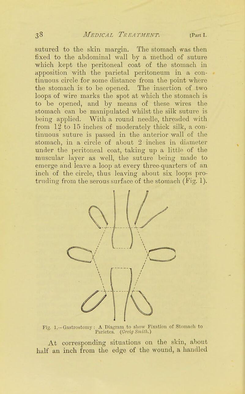 sutured to the skin margin. The stomach was then fixed to the abdominal wall by a method of suture which kept the peritoneal coat of the stomach in apposition with the parietal peritoneum in a con- tinuous circle for some distance from the point where the stomach is to be opened. The insertion of two loops of wire marks the spot at which the stomach is to be opened, and by means of these wires the stomach can be manipulated whilst the silk suture is being applied. With a round needle, threaded with from 12 to 15 inches of moderately thick silk, a con- tinuous suture is passed in the anterior wall of tlie stomach, in a circle of about 2 inches iii diameter under the peritoneal coat, taking up a little of the muscular layer as well, the suture being made to emerge and leave a loop at every three-quarters of an inch of the circle, thus leaving about six loops pro- truding from the serous surface of the stomach (Fig. 1). Fig. 1.—Gastrostomy : A 'Diagvam to show Fixation of Stoiiiadi to Pai'ictcs. {Grng Smith.) At corresponding situations on the skin, about half an inch from the edge of the wound, a handled