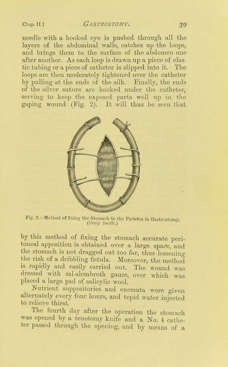 needle with a hooked eye is pushed through all the layers of the abdominal walls, catches up the loops, and brings them to the surface of the abdomen one after another. As each loop is drawn up a piece of elas tic tubing or a piece of catheter is slipped into it. The loops are then modex'ately tightened over the catheter by pulling at the ends of the silk. Finally, the ends of the silver suture are hooked under the catheter, serving to keep the exposed parts well up in the gaping wound (Fig. 2). It will thus be seen that Fig. 2.-Method of flxing the Stomach to the Parietes in Gastrostomy, (Greiy Smith.) by this method of fixing the stomach accurate peri- toneal ai)position is obtained over a large spacJe, and the stomach is not dragged out too far, thus lessening the risk of a dribbling fistula. Moreover, the method is rapidly and easily carried out. The wound was dressed with sal-alembroth gauze, over which was placed a large pad of salicylic wool. Nutrient suppositories and enemata were given alternately every four hours, and tepid w^ater injected to relieve thirst. The fourth day after the operation the stomach was opened by a tenotomy knife and a No. 4 cathe- ter passed through the opening, and by means of a