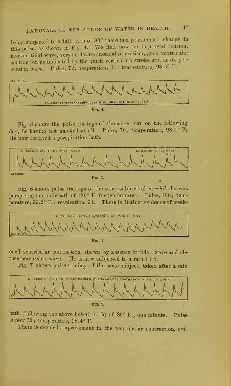 being subjected to a full bath of 80° there is a pronounced change in this pulse, as shown in Fig. 4. We find now an improved tension, marked tidal wave, very moderate (normal) dicrotism, good ventricular contraction as indicated by the quick vertical up stroke and acute per- cussion wave. Pulse, 72; respiration, 21; temperature, 98.6° F. JAN. 2, '97. Fia. 4. Fig. 5 shows the pulse tracings of the same man on the following day, he having not smoked at all. Pulse, 70; temperature, 98.4° F. He now received a perspiration bath. 1. TAUaSIQ - JAN^ a. -'97c P. 70 - T. 9S..4. BEFORE HOT AIR BATH 180° it YEARS Fis. 5. ■n Fig. 6 shows pulse tracings of the same subject taken vhile he was perspiring in an air bath of 180° F. for ten minutes. Pulse, 100; tem- perature, 99.2° F.; respiration, 94. There is distinct evidence of weak- 2. TAU8S1Q-IN HOTAIR BATH 180 P, JOO-T.99.2. - R. 24. Fia. 6. ened ventricular contraction, shown by absence of tidal wave and ob- tuse percussion wave. He is now subjected to a rain bath. Fig. 7 shows pulse tracings of the same subject, taken after a rain 9. TAU88IQ - JAN. 2, '97. .AFTER RAIN BATH(fOLLOWINGHOT/,I.H,BATtl) 80°- 1 M..- P. 72 - T. 98.4 Fig. 7. bath (following the above hot-air bath) of 80° F., one minute. Pulse is now 72; temperature, 98.4° F. There is decided improvement in the ventricular contraction, evi-