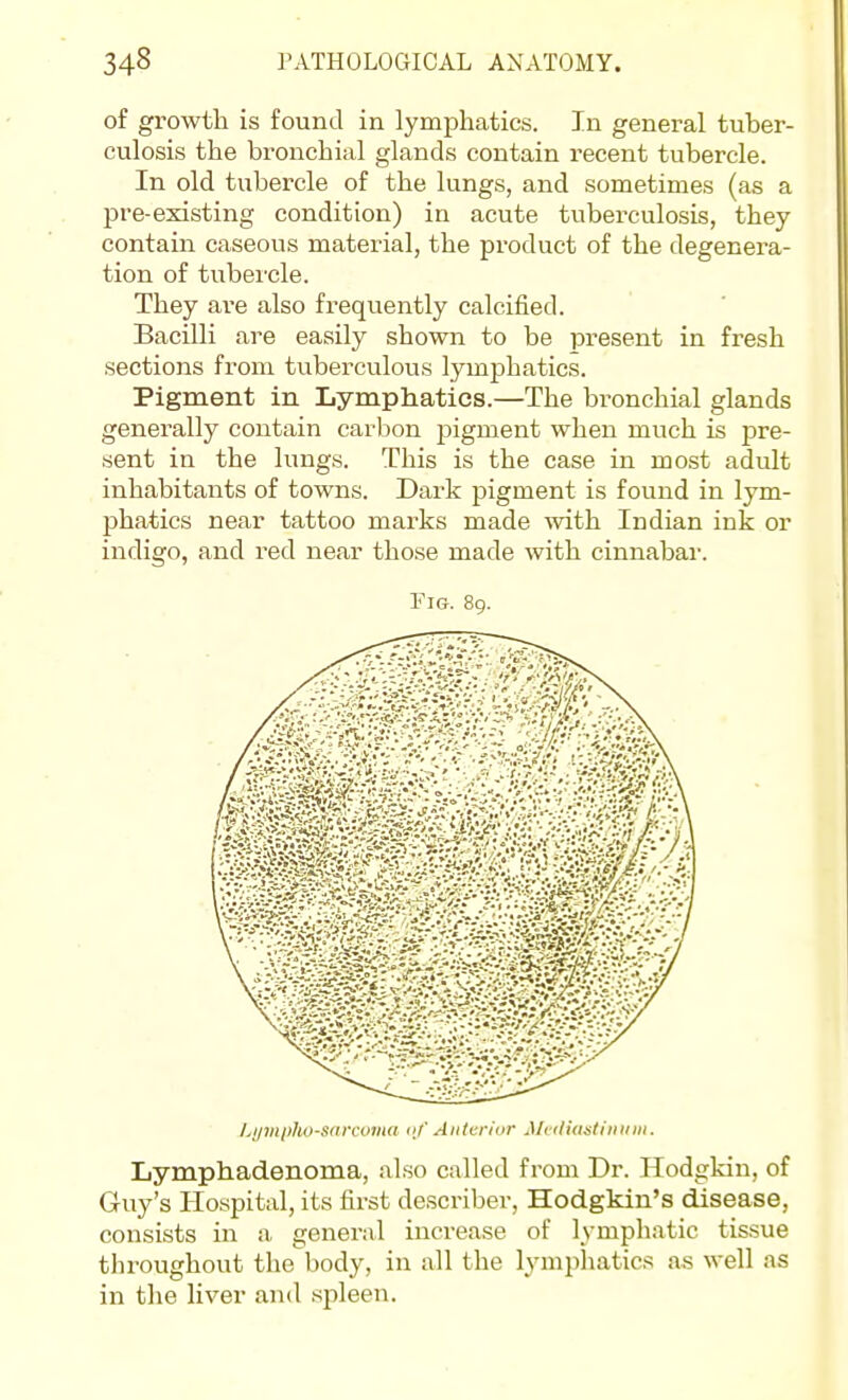of growth is found in lymphatics. In general tuber- culosis the bronchial glands contain recent tubercle. In old tubercle of the lungs, and sometimes (as a pre-existing condition) in acute tuberculosis, they contain caseous material, the product of the degenera- tion of tubercle. They are also frequently calcified. Bacilli are easily shown to be present in fresh sections from tuberculous lymphatics. Pigment in Lymphatics.—The bronchial glands generally contain carbon j^igment when much is pre- sent in the lungs. This is the case in most adult inhabitants of towns. Dark pigment is found in lym- phatics near tattoo marks made ^vith Indian ink or indigo, and red near those made with cinnabar. Fig. 89. Lymplio-sarcuvia nf Anterior ^h■(lia:itilllllll. Lymphadenoma, also called from Dr. Hodgkin, of Guy's Hospital, its first describer, Hodgkin's disease, consists in a, general increase of lymphatic tissue throughout the body, in all the lymphatics as well as in the liver and spleen.