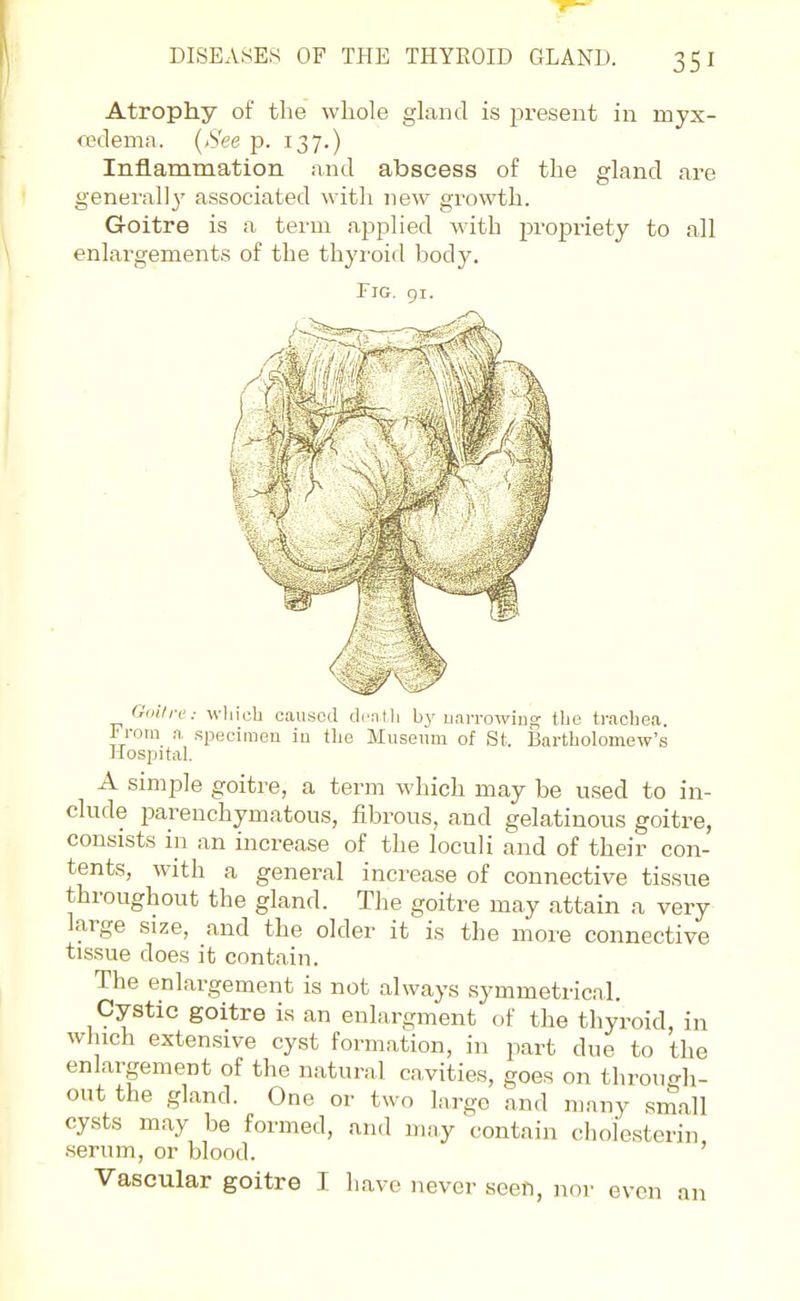 Atrophy of the whole gland is present in myx- cedema. {See p. 137.) Inflammation and abscess of the gland are generall}' associated with new growth. Goitre is a tei-m applied with propriety to all enlargements of the thyroid body. Fig. 91. Goin-e: wliicb caused dcatli by uarrowiug the trachea. I' roin a specimen in the Museum of St. ]3artholomew's liospital. A simple goitre, a term which may be used to in- clude parenchymatous, fibrous, and gelatinous goitre, consists in an increase of the loculi and of their con- tents, with a general increase of connective tissue throughout the gland. The goitre may attain a very large size, and the older it is the more connective tissue does it contain. The enlargement is not always symmetrical. Cystic goitre is an enlargment of the thyroid, in which extensive cyst formation, in part due to the enlargement of the natural cavities, goes on through- out the gland. One or two large and many small cysts may be formed, and may contain cholesterin .serum, or blood. ' Vascular goitre I Lave never seen, nor even an