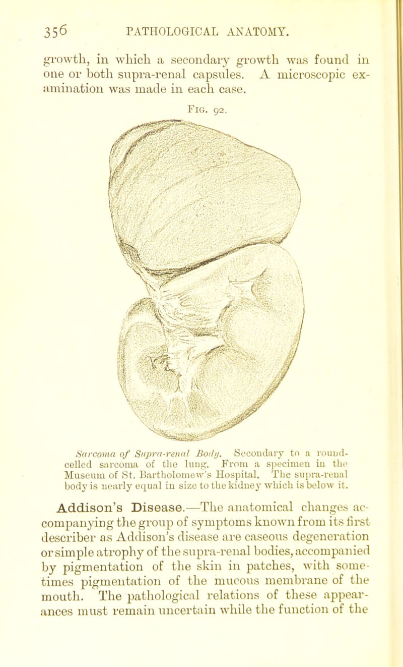 gi'owtli, in which a secondary growth was found in one or both supra-renal capsules. A microscopic ex- amination was made in each case. Fig. 92. Siircovia of Siiprii-reiu(/ Boily. Secoudaiy tn a rouud- celled sarcoma of the luug. From a specimen iu tli.^ Museum of St. Bartholomew's Hospital. The supra-reual body is uearly equal iu size to the kiduey which is below it. Addison's Disease.—The anatomical changes ac- companjdng the group of symptoms known from its lirst describer as Addison's disease are caseous degeneration or simple atrophy of the supra-renal bodies, accompanied by pigmentation of the skin in patches, with some- times pigmentation of the mucous membrane of the mouth. The pathological relations of these appear- ances must remain uncertain while the function of the