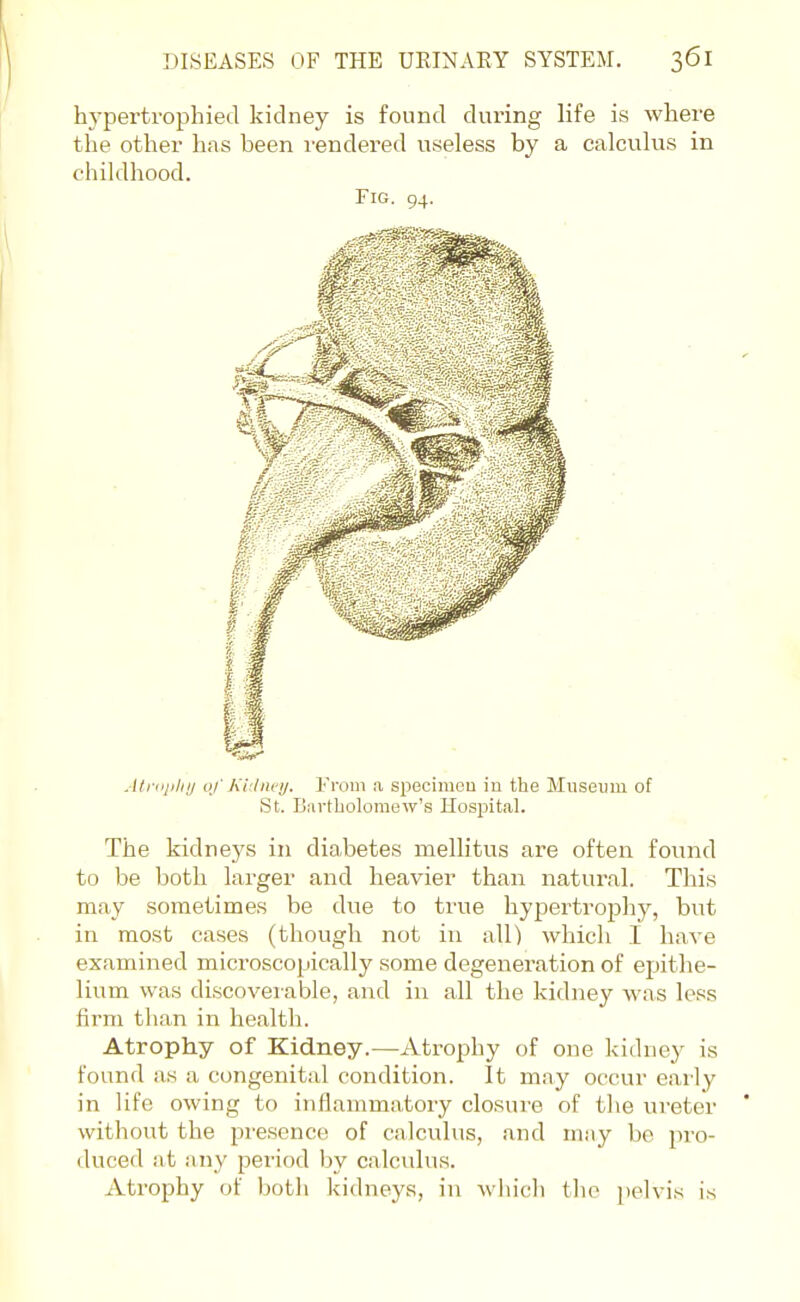 hypertrophied kidney is found during life is where the other has been rendered useless by a calculus in childhood. Fig. 94. Atriipliij oj'Ki'liu'ij. From a specimou in the Museum of St. Biivtboloraew's Hospital. The kidneys in diabetes mellitus are often found to be both larger and heavier than natural. This may sometimes be due to true hypertrophy, but in most cases (though not in all) which I have examined microscopically some degenei'ation of epithe- lium was discoverable, and in all the kidney was less firm than in health. Atrophy of Kidney.—Atrophy of one kidney is found as a congenital condition. It may occur early in life owing to inflammatory closure of the ureter without the presence of calculus, and may be pro- duced at any period by calculus. Atrophy of both kidneys, in which tbo j'elvis is