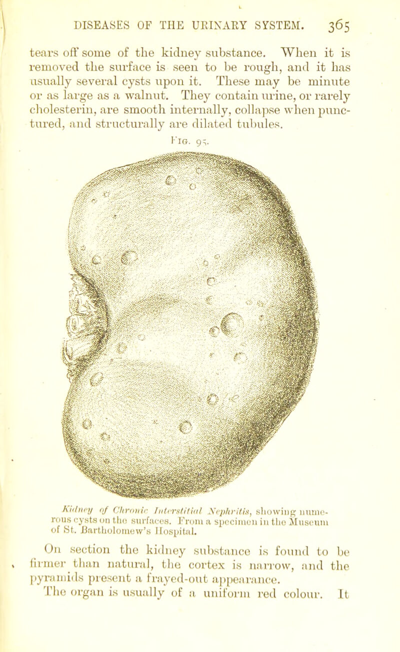 tears off some of the kidney substance. When it is removed the surface is seen to be rough, and it has usually several cysts upon it. These may be minute or as lai'ge as a walnut. They contain urine, or rarely cholesterin, are smooth internally, collapse when punc- tured, and structurally are dilated tubules. I'IG. 9S. Kidiicy rif CliriDiir IiiUr-tlilnil A cyo-rf/.s-, showiiip; iiume- rcjus i-ysts on tlu! sui-f.-iccH. rrom a spccniiuii in the Miisciiin of at. Bartholoiuew'.s llospitiil. On section the Idchiey substance is fomid to bo firmei- than natural, tlio cortex is narrow, and tlio pyraiiiids piesent a frayed-out appearance. The organ is usually of a unifuriu red colour. It