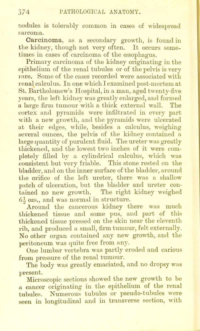 nodules is tolerably common in cases of widespread sarcoma. Carcinoma, as a secondary growth, is found in the kidney, though not very often. It occurs some- times in cases of carcinoma of the oesophagus. Primary carcinoma of the kidney originating in the epithelium of the renal tubviles or of the jielvis is very rnre. Some of the cases recorded were associated with renal calculus. In one which I examined post-mortem at St. Bartholomew's Hospital, in a man, aged twenty-five years, the left kidney was greatly enlarged, and formed a large firm tumour with a thick external wall. The cortex and pyi\amids were infiltrated in everj' part with a new growth, and the pyramids were ulcerated at their edges, while, besides a calculus, weighing several ounces, the pelvis of the kidney contained a large quantity of purulent fluid. The ureter was greatly thickened, and the lowest two inches of it were com- pletely filled by a cylindrical calculus, which was consistent but very friable. This stone rested on the bladder, and on the inner surface of the bladder, around the orifice of the left ureter, there was a shallow patch of ulceration, but the bladder and ureter con- tained no new growth. The right kidney weighed 6i ozs., and was normal in structure. Around the cancerous kidney there was much thickened tissue and some pus, and part of this thickened tissue pressed on the skin near the eleventh rib, and produced a small, firm tumoui-, felt externally. No other organ contained any new gi'owth, and the peritoneum was quite free from any. One lumbar vertebra was partl}^ eroded and carious from pressure of the i-enal tumour. The body was greatly emaciated, and no dropsy Wi\s present. Microscopic sections showed the new growth to be a cancer originating in the epithelium of the renal tubules. Numerous tubules or pseudo-tubules were seen in longitudinal and in transverse section, Avith
