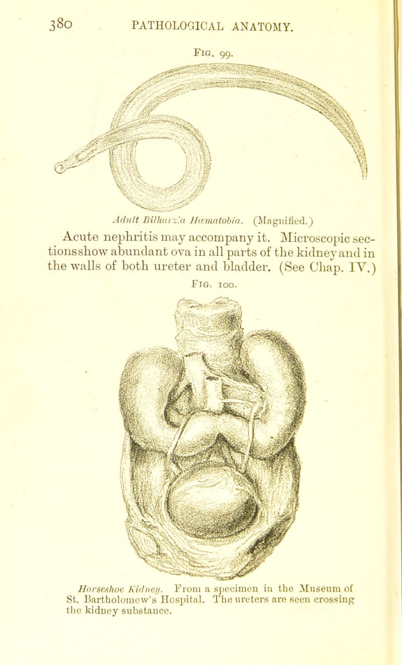 Fig. 99. Adult Bilhurz'.a Hmnatobia. (Magnified.) Acute neijhritis may accompany it. Microscopic sec- tionsshow abundant ova in all parts of the kidneyand in the walls of both ureter and bladder. (See Chap. lY.) Fig. 100. Horseshoe Kiilntji. From a spocimon in tho Museum of St. Bartholoiiiew'.s Hospital. TIki urcter.s are seen crossing the kiduey substance.