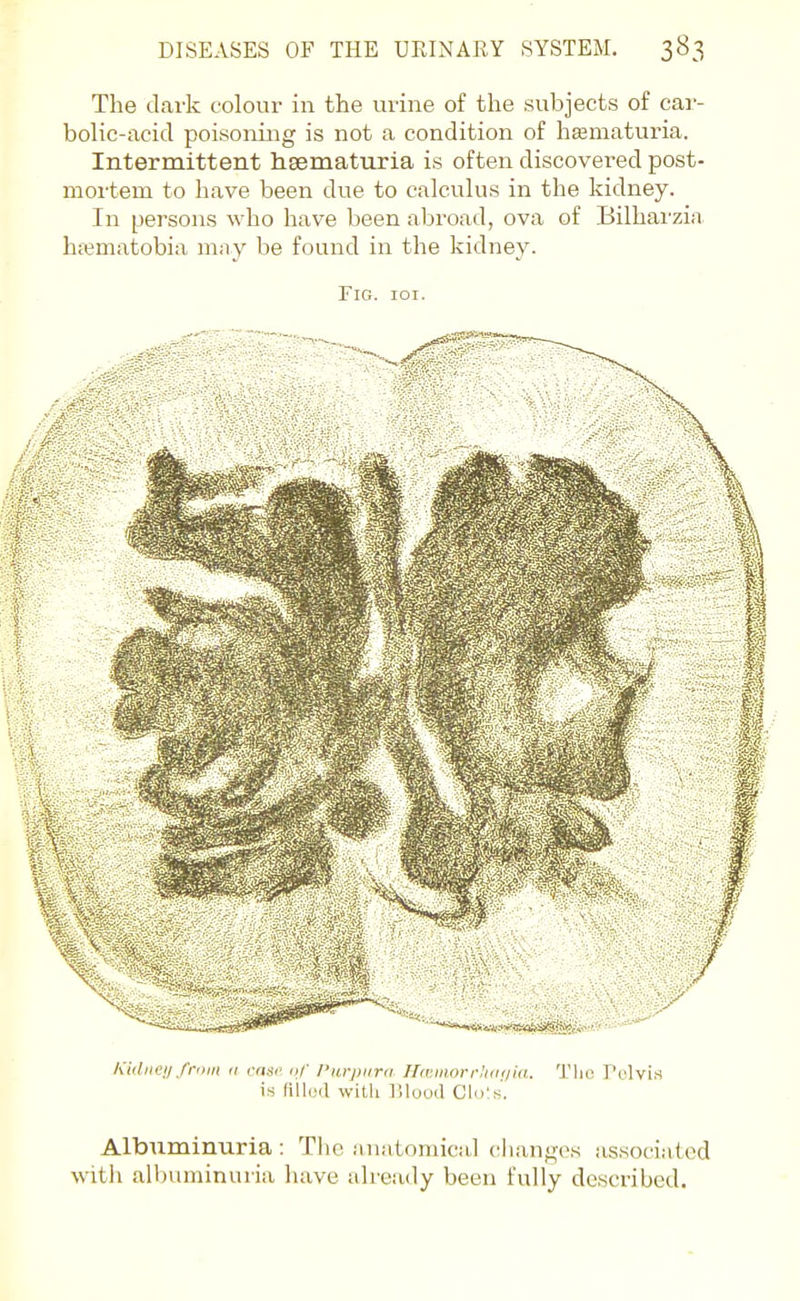 The dark colour in the urine of the subjects of car- bolic-acid poisoning is not a condition of haematuria. Intermittent hsematuria is often discovered post- mortem to have been due to calculus in the kidney. In persons who have been abroad, ova of Bilharzia hajmatobia may be found in the kidney. Fig. ioi. Kidneu from a case. <;/' I'wpiirii Ihviaorduiuia. Tlio r'clvi.s is fillud with ]!lood Glols. Albuminuria : The anatomical changes associated witii alljuminuria have already been fully described.