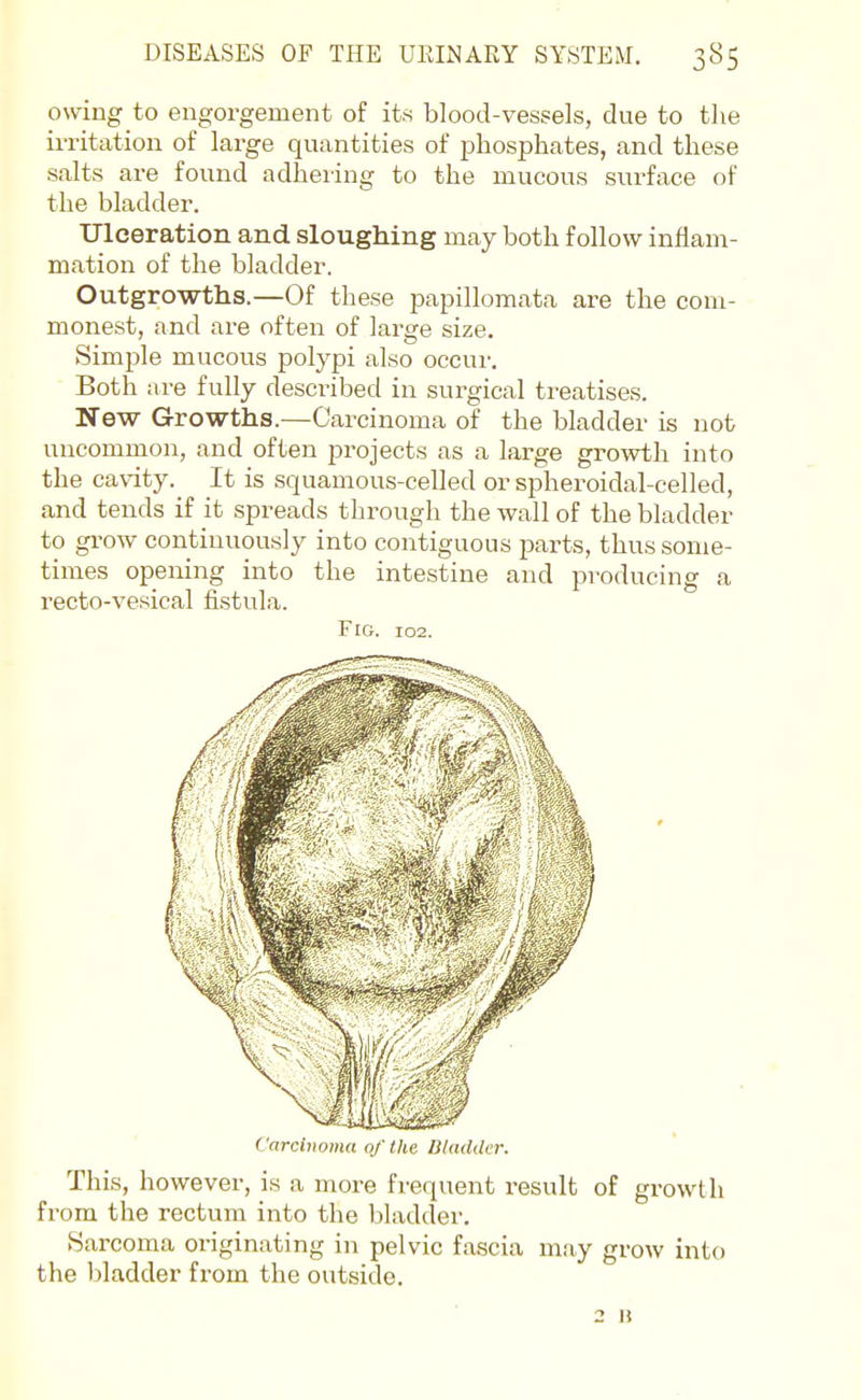 owing to engorgement of its blood-vessels, due to tlie irritation of large quantities of phosphates, and these salts are found adhering to the mucous surface of the bladder. Ulceration and sloughing may both follow inflam- mation of the bladder. Outgrowths.—Of these papillomata are the com- monest, and are often of large size. Simple mucous polypi also occur. Both are fully described in surgical treatises. New Growths.-—Carcinoma of the bladder is not uncommon, and often projects as a large growth into the cavity. It is squamous-celled or spheroidal-celled, and tends if it spreads through the wall of the bladder to grow continuously into contiguous parts, thus some- times opening into the intestine and producing a recto-vesical fistula. Fig. 102. Carcinoma of the Bladder. This, however, is a more frequent result of growth from the rectum into the bladder. Sarcoma originating in pelvic fascia may grow into the bladder from the outside. 2 It