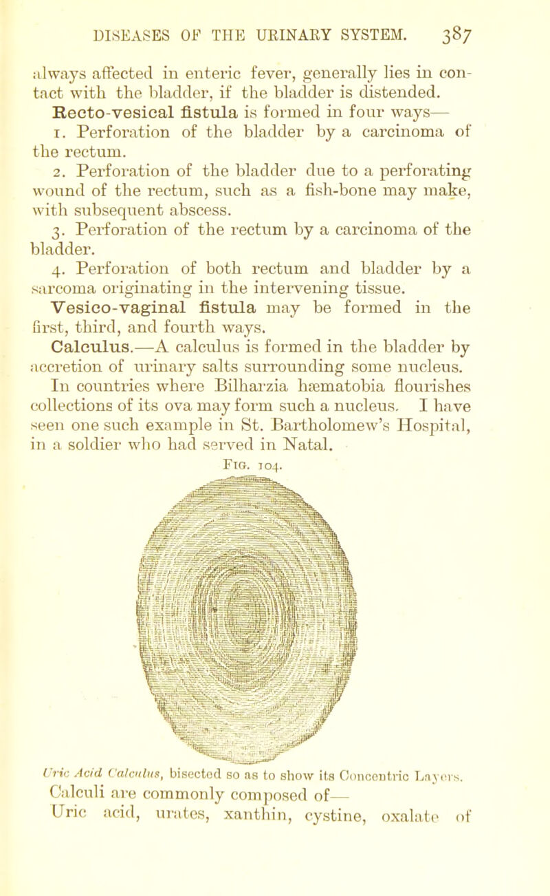 always affected in enteric fever, generally lies in con- tact with the bladder, if the bladder is distended. Recto-vesical fistula is formed in fonr ways— 1. Perforation of the bladder by a carcinoma of the rectum. 2. Perforation of the bladder due to a perforating wound of the rectum, such as a iish-bone may make, with subsequent abscess. 3. Perforation of the I'ectum by a carcinoma of the bladder. 4. Perforation of both rectum and bladder by a sarcoma originating in the intervening tissue. Vesico-vaginal fistula may be formed in the first, third, and fourth ways. Calculus.—A calculus is formed in the bladder by accretion of minary salts surrounding some nucleus. In countries where Bilhai'zia hasmatobia flouiishes collections of its ova may form such a nucleus. I have seen one such example in St. Bartholomew's Hospital, in a soldier wlio had served in Natal. ■ Fig. J04. Uric Acid Calculus, bisected so us to sliow its Ocincoutric Lavcvs. Calculi are commonly composed of— Uric acid, urates, xanthin, cystine, oxalate of