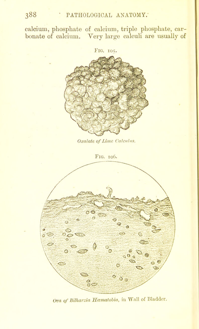 calcium, phosphate of calcivim, ti'iple phosphate, car- bonate of calcium. Very lai'ge calculi are usually of Fig. 105. Ova of nUharzia Hmmtohia, in W:\ll of Bladder.