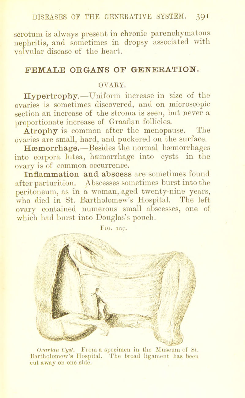 scrotum is always present in chronic parenchymatous nephritis, and sometimes in dropsy associated with valvular disease of the heart. FEMALE ORGANS OF GENERATION. OVARY. Hypertrophy.—Uniform increase in size of the ovaries is sometimes discovered, and on microscopic section an increase of the stroma is seen, but never a proportionate increase of Graafian follicles. Atrophy is common after the menopause. The ovaries are small, hard, and puckered on the surface. Haemorrhage.—Besides the normal haemorrhages into corpora lutea, htemorrhage into cysts in tlie ovary is of common occurrence. Inflammation and abscess are sometimes found after parturition. Abscesses sometimes burst into the peritoneum, as in a woman, aged twenty-nine years, who died in St. Bartholomew's Plospital. The left ovary contained luimerous small abscesses, one of which had burst into Douglas's pouch. Fig. 107. orarian Lysi. i' loiii 11 spi^uimcu ui 1.110 Museum of St. liartholomow's Hospital. 'J'hc broad ligiiment has bcfu cut away ou ono side.