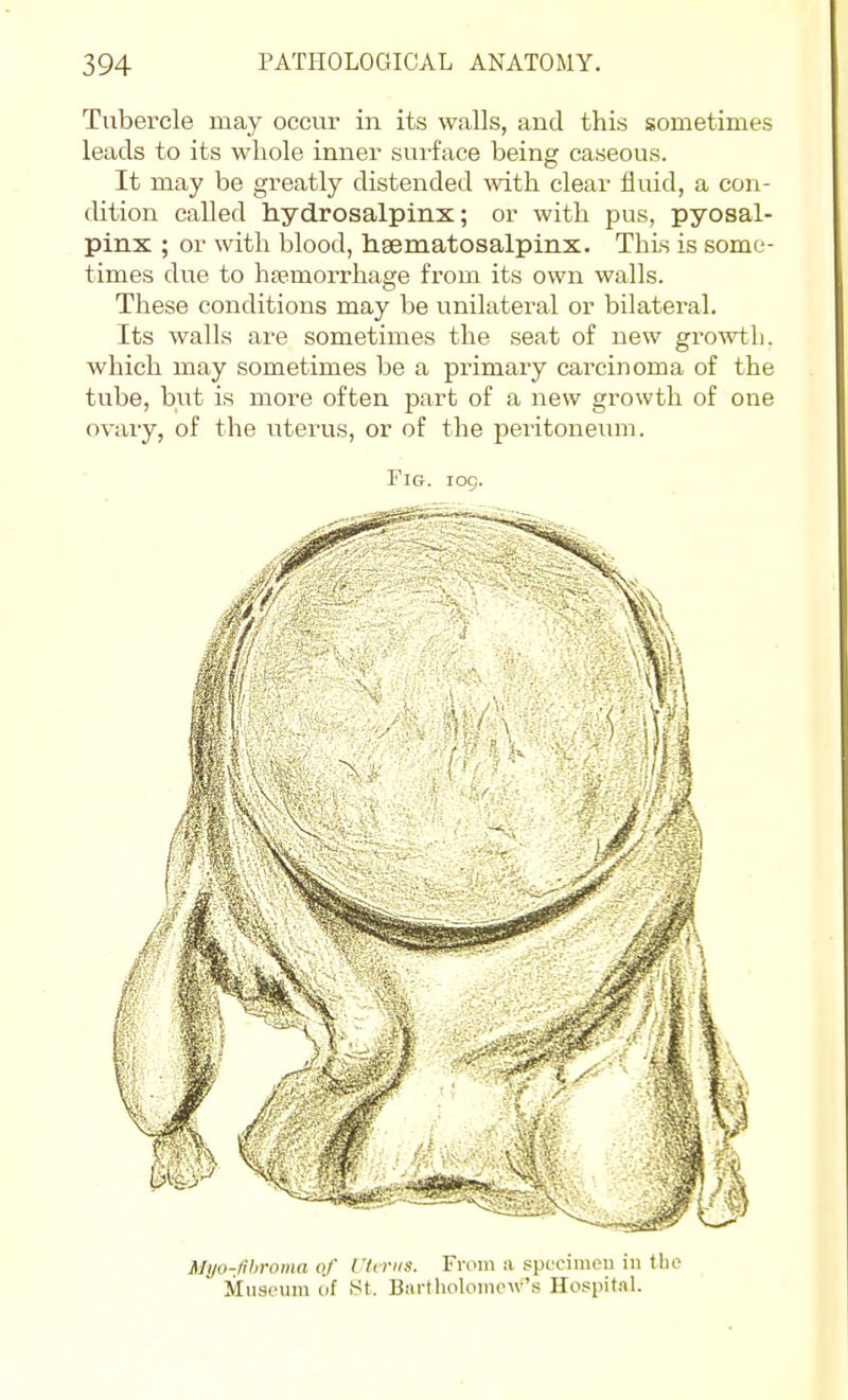 Tubercle may occur in its walls, and this sometimes leads to its whole inner suiface being caseous. It may be greatly distended with cleai' fluid, a con- dition called hydrosalpinx; or with pus, pyosal- pinx ; or with blood, hsematosalpinx. This is some- times due to hsemorrhage from its own walls. These conditions may be unilateral or bilateral. Its walls are sometimes the seat of new growth, which may sometimes be a primary carcinoma of the tube, but is more often part of a new growth of one ovary, of the uterus, or of the peritoneum. Fig. 109. Mijo-fihroma of I 'Icnis. Froni a spcoimeu in tlio Museum of St. Bartholomew's Hospital.