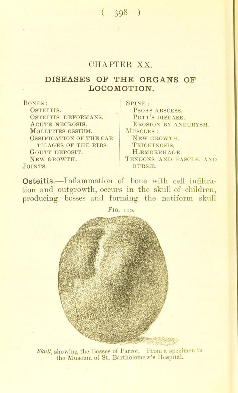 CHAPTER XX. DISEASES OP THE ORGANS OF LOCOMOTION. Bones: Osteitis. Osteitis defoemans. Acute neceosis. Mollities ossium. Ossification of the cae- tilages of the eibs. Goutt deposit. New C4E0WTH. Joints. Spine: Psoas abscess. Pott's disease. Erosion by aneueysm. Muscles : New geowth. Trichinosis. HiEMOEEHAGE. Tendons and fascia and BURS^. Osteitis.—Inflammation of bone with cell infiltra- tion and outgrowth, occurs in the skull of children, producing bosses and forming the natiform skull Fig. no. Skull, sliowing tho Ikisses of rnrrot. Krom a spociiui'U in the Musciiiii of St. Bartholomew's Hospital.