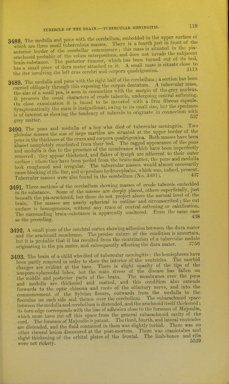 qdfift The medulla aucl pons with the cerebellum, embedded in the upper surface of ^ wSd' veu'ree small tuberculous masses. There is a fourth just m trout o± the ^, te orbmTer ot the cerebellar commissure; this mass is situated lu the pia- t^ldv^ol^My of the velum interposit.uu aud does -^^^f^^^^^^ hvVm substauce The posterior tumour, which has been turned out ot its Decl, has a Wf pte of dura mater attached to it. A small mass is situate close to the iter iuvolving the loft cnis cerebri and corpora cpadngemma. ^J-i^ q4fiq The medulla and pous with the right half of the cerebellum; a section has been ^ caLd obCely through this exposin| the corpus dentatum. A tubercular mass, t^e siLTa small pea,''is seen in connection with the margin of the grey nucleus. It presents the usual characters of crude tubercle, undergoing central softening. On close examination it is found to be invested vdth a hrm fibrous capsule Symptomatically the mass is iusiguificant, ouing to its small size, but the specimen is of interest as showing the tendency of tubercle to originate m connection w^ith grey matter. 3490 The pons and medulla of a boy who died of tubercular meningitis. Two globular masses the size of large marbles are situated at the upper border of the Sons in the thickness of the crura and corpora quadrigemma Both masses have been almost completely enucleated from their bed. The ragged appearance of the pons and medulla is due to the presence of the membranes which have been imperfectly removed ; they appear thickened, and flakes ot lymph are adherent to then- outer surface : where they have been peeled from the brain-matter, the pons and medulla look roughened and irregular. The tubercular masses would almost necessarily cause blocking of the iter, and so produce hydrocephalus, which was, indeed, present Tubercular masses were also found in the cerebellum (No. 3491). 4d/ 3491 Three sections of the cerebellum showmg masses of crude tubercle embedded in its substance. Some of the masses are deeply placed, others superhciaUy ]ust beneath the pia-arachnoid, but these do not project above the normal level of the brain. The masses are nearly spherical in outhne and circumscribed ; the cut surface is homogeneous, without any trace of central softening or calcification. The surrounding brain-substance is apparently unaltered. From the same case as the preceding. 3492 A ^mall piece of the cerebral cortex showing adhesion between the dura mater and the arachnoid membrane. The precise nature of the condition is uncertain, but it is probable that it has resulted from the cicatrization of a tubercular nodule originating in the pia mater, and subsequently affecting the dura mater. S75b 3493 The brain of a child who died of tubercular meningitis : the hemispheres have been partly removed in order to show the interior of the ventricles The morbid changes are evident at the base. There is slight opacity of the tips of the tempore-sphenoidal lobes, but the main stress of the disease has fallen on the middle and posterior parts of the brain. The membranes over the pons and medulla are thickened and matted, and tliis condition also extends forwards to the optic chiasm a and roots of the olfactory nerve, and into the commencement of the Sylvian fissure, outwards from the medulla to the flocculus on each side and thence over the cerebellum. The subarachnoid space between the medulla and cei-eb(!llum is distended, and the arachnoid itself thickened ; its torn ed^e corresponds with the line of adhesion close to the foramen o£ Majendie, which musi- have cut off this spacie from the general subaraclinoid cavity of the cord. The foramen of Majendie is patent. The tliird, fourth, and lateral ventricles are distended, and the fluid contained in them was slightly turbid. There was no other visceral lesion discovered at the post-mortem. There was craniotabes and slight thickening ol! the orbital plates of the frontal. The limb-bones aud^ribs were not rickety. '^'^