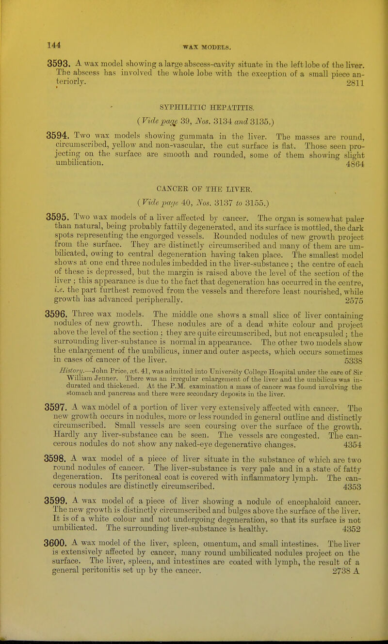 f 144 WAX MODELS. 3593. A wax model showing a large abscess-cavity situate in the left lobe of the liver. The abscess has involved the whole lobe ^vith the exceptioji of a small piece an- teriorly. 2811 SYPHILITIC HEPATITIS. {Videpag^ 39, Nos. 3134ancZ3135.) 3594. Two wax models showing gummata in the liver. The masses are round, circumscribed, yellow and non-vascular, the cut surface is flat. Those seen pro- jecting on the surface are smooth and rounded, some of them showing slight umbilicatiou. 4864 CANCER OF THE LIVER. {Videpaye 40, Nos. 3137 to 3155.) 3595. Tm'o w ax models of a liver affected by cancer. The organ is somewhat paler than natural, being probably fattily degenerated, and its surface is mottled, the dark spots representing the engorged vessels. Bounded nodvdes of new growth project from the surface. They are distinctly circumscribed and many of them are um- bilicated, owing to central degeneration having taken place. The smallest model shows at one end three nodules imbedded in the liver-substauce ; the centre of each of these is depressed, but the margin is raised above the level of the section of the liver ; this appearance is due to the fact that degeneration has occui-red in the centre, i.e. the part furthest removed from the vessels and therefore least nourished, while growth has advanced peripherally. 2575 3596. Three wax models. The middle one shows a small slice of liver containing nodules of new growth. These nodules are of a dead white colour and project above the level of the section ; they are quite circumscribed, but not encapsuled; ithe surrounding liver-substance is normal in appearance. The other two models show the enlargement of the umbilicus, inner and outer aspects, which occm-s sometimes in cases of cancer of the liver. 5338 History.—So\m Price, ret. 41, was admitted into University College Hospital under the care of Sir William Jenner. There was an irregular enlargement of the liver and the umbilicus was in- durated and thickened. At the P.M. examination a muss of cancer was found involving the stomach and pancreas and there were secondary deposits in the liver. 3597. A wax m6del of a portion of liver very extensively affected with cancer. The new growth occurs in nodules, more or less rounded in general outline and distinctly circumscribed. Small vessels are seen coursing over the surface of the growth. Hardly any liver-substance can be seen. The vessels are congested. The can- cerous nodules do not show any naked-eye degenerative changes. 4354 3598. A wax model of a piece of liver situate in the substance of which are two round nodules of cancer. The liver-substance is very pale and in a state of fatty degeneration. Its peritoneal coat is covered with inflaromatory lymph. The can- cerous nodules are distinctly circumscribed. * 4353 3599. A wax model of a piece of liver showing a nodule of encephaloid cancer. The new growth is distinctly circumscribed and bidges above the surface of the liver. It is of a white colour and not undergoing degeneration, so that its surface is not umbilicated. The surrounding liver-substance is healthy. 4352 3600. A wax model of tlie liver, spleen, omentum, and small intestines. The liver is extensively affected by cancer, many round umbilicated nodules project on the surface. The liver, spleen, and intestines are coated with lymph, the result of a general peritonitis set up by the cancel-. 2738 A